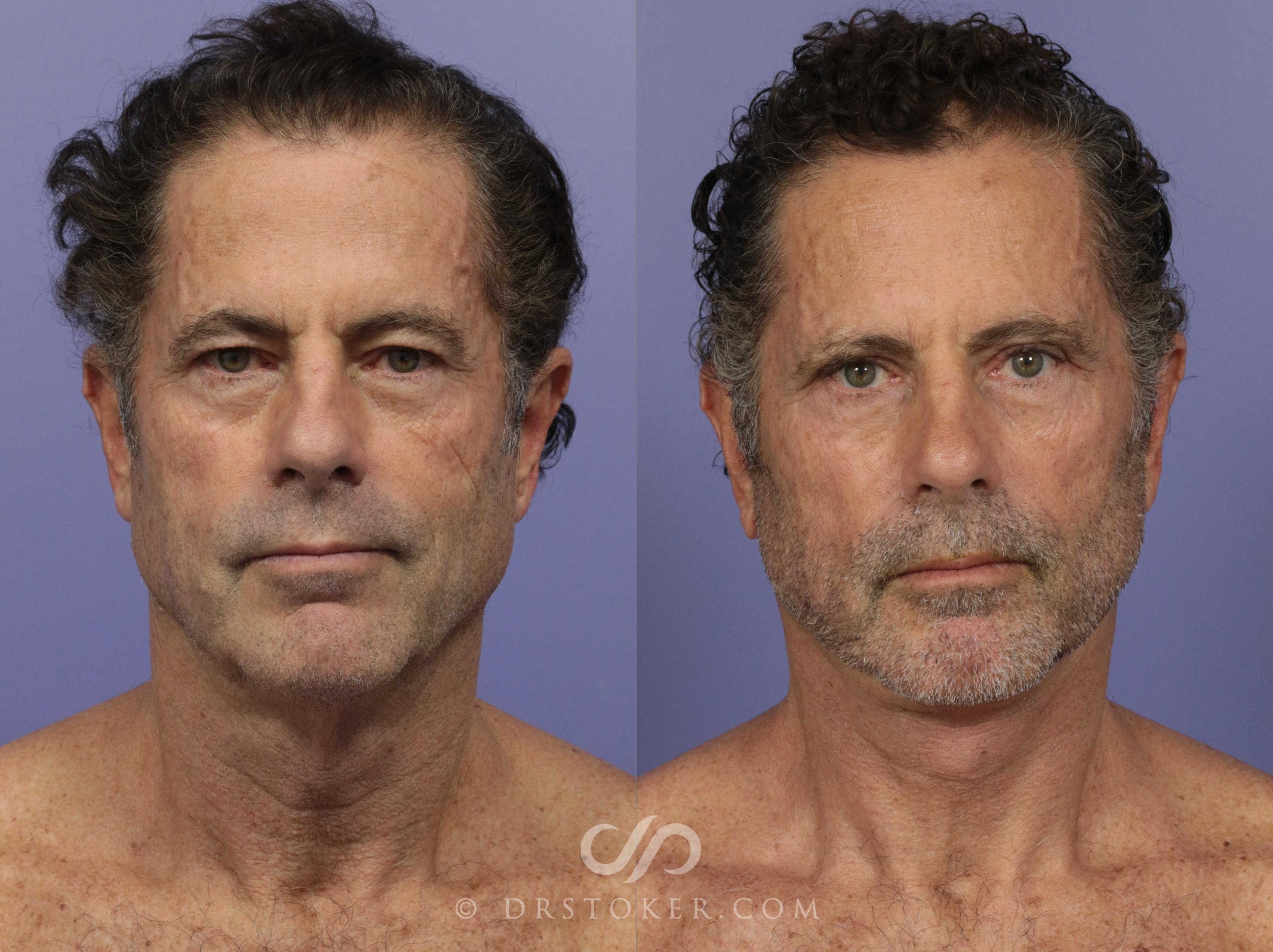Before & After Neck Lift for Men Case 814 View #1 View in Los Angeles, CA