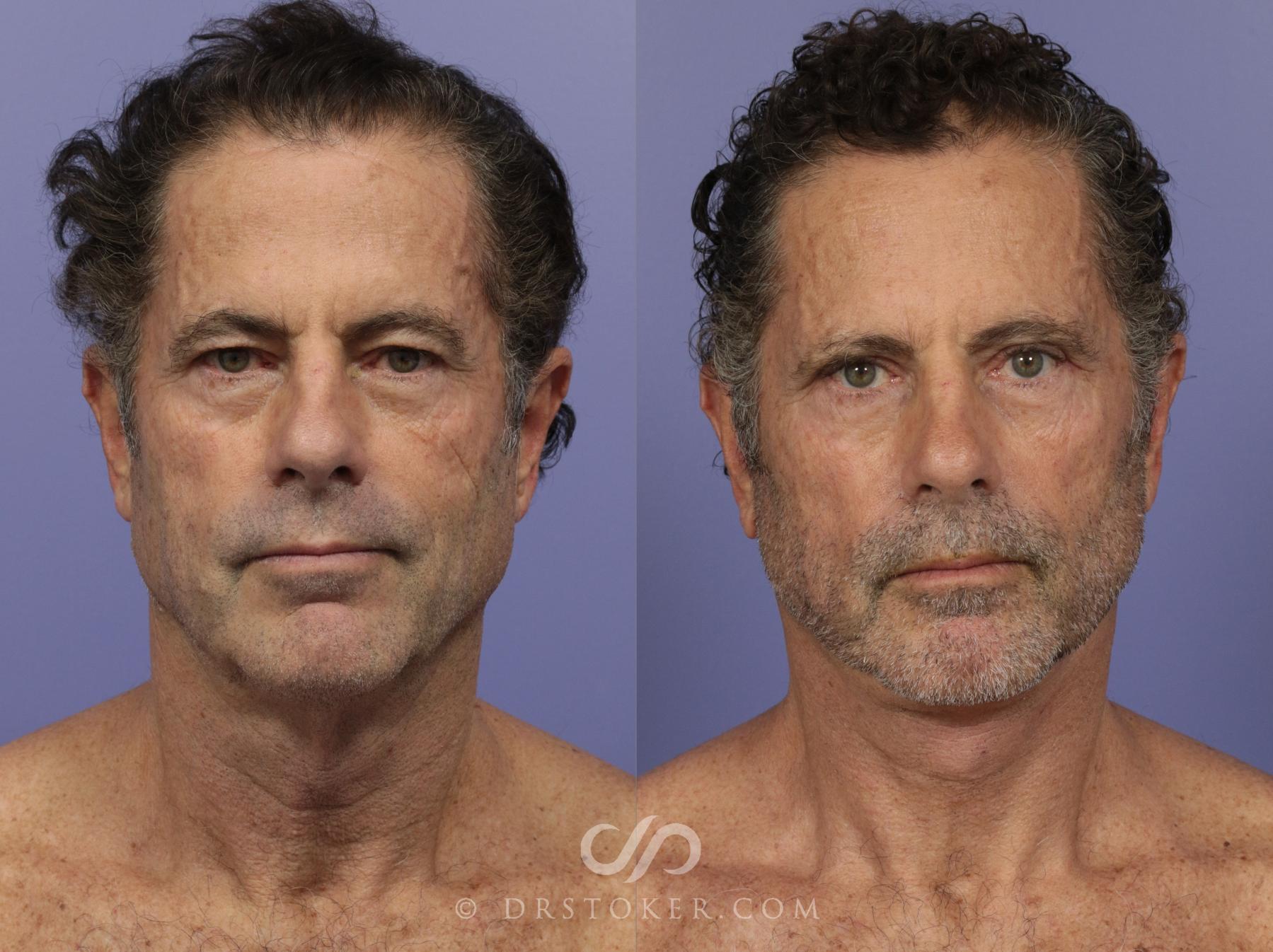 Before & After Neck Lift for Men Case 814 View #1 View in Los Angeles, CA