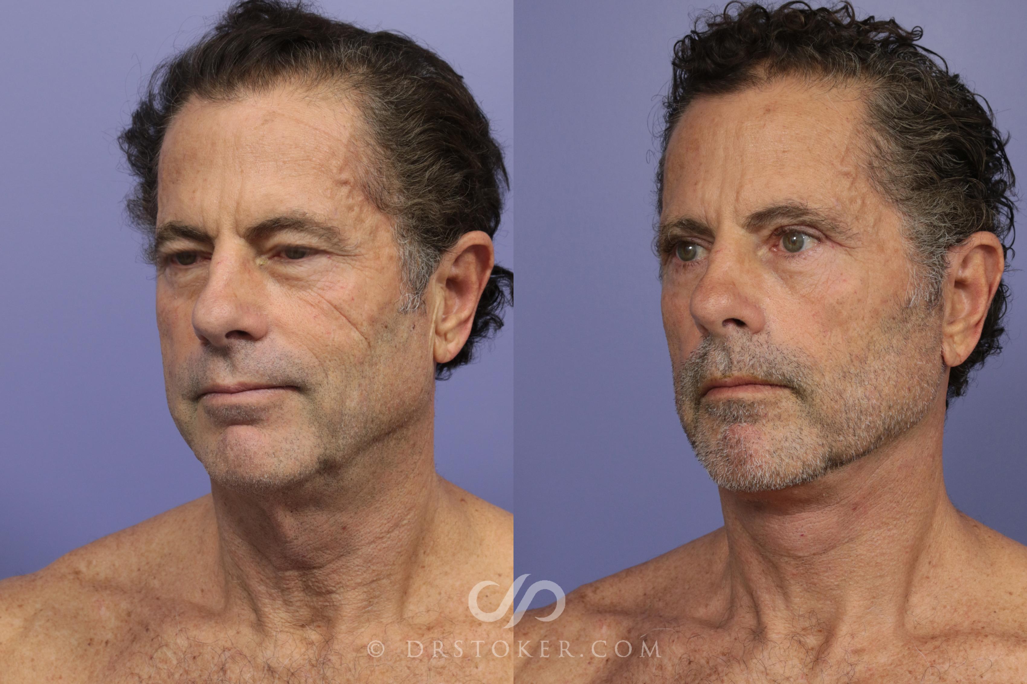 Before & After Facelift - Traceless Facelift Case 814 View #2 View in Los Angeles, CA