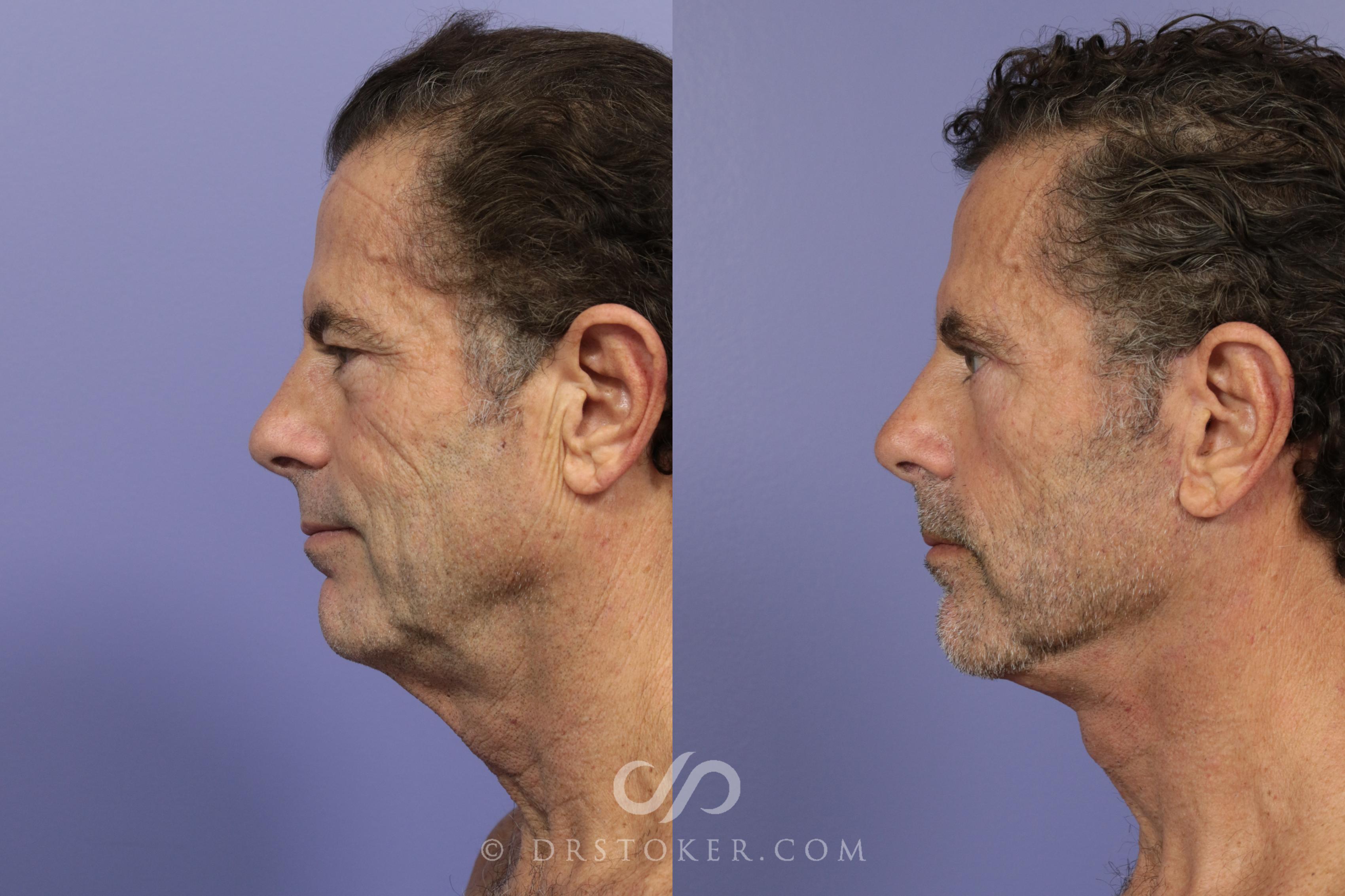 Before & After Facelift - Traceless Facelift Case 814 View #3 View in Los Angeles, CA