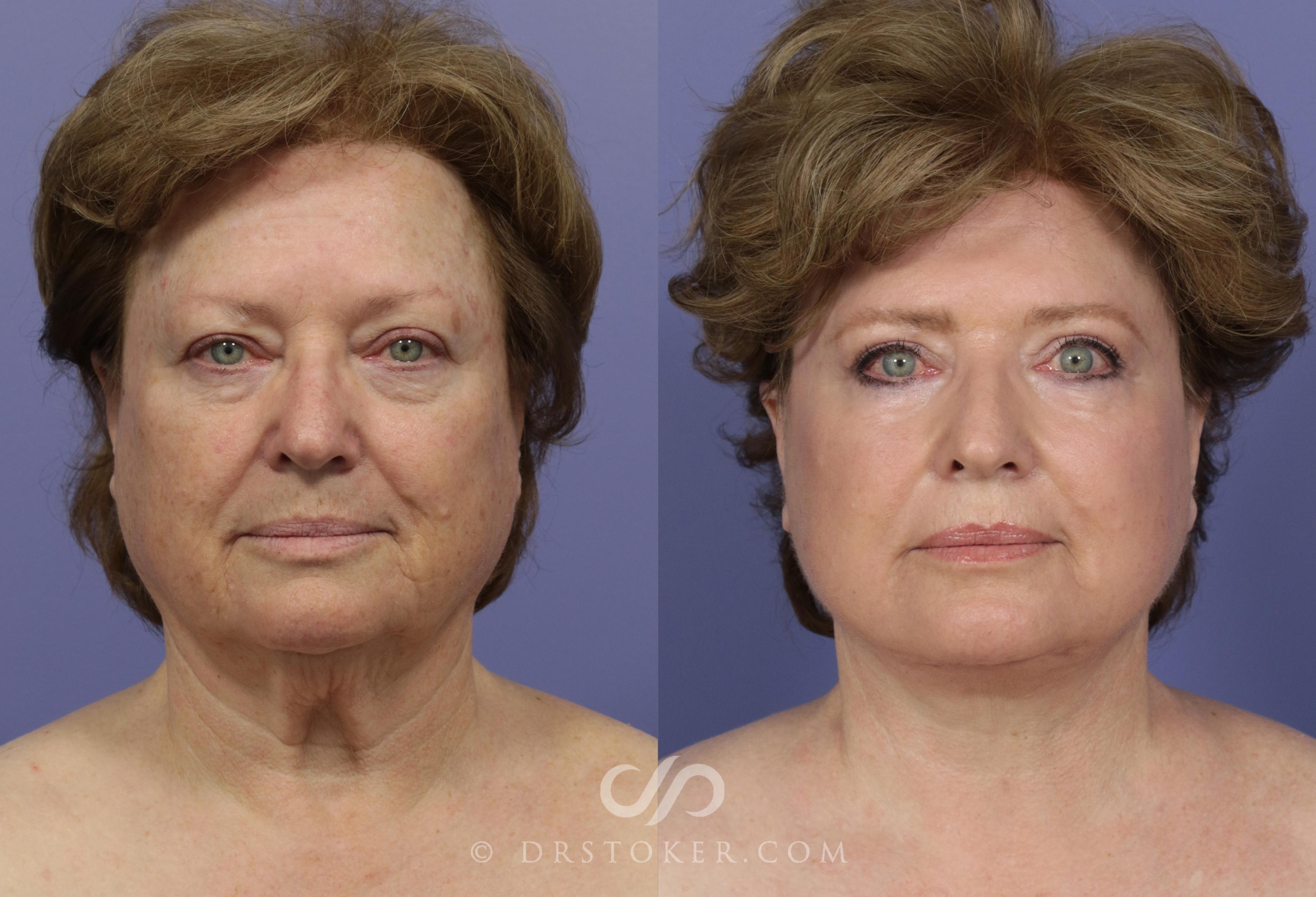 Before & After Facelift - Traceless Facelift Case 817 View #1 View in Los Angeles, CA