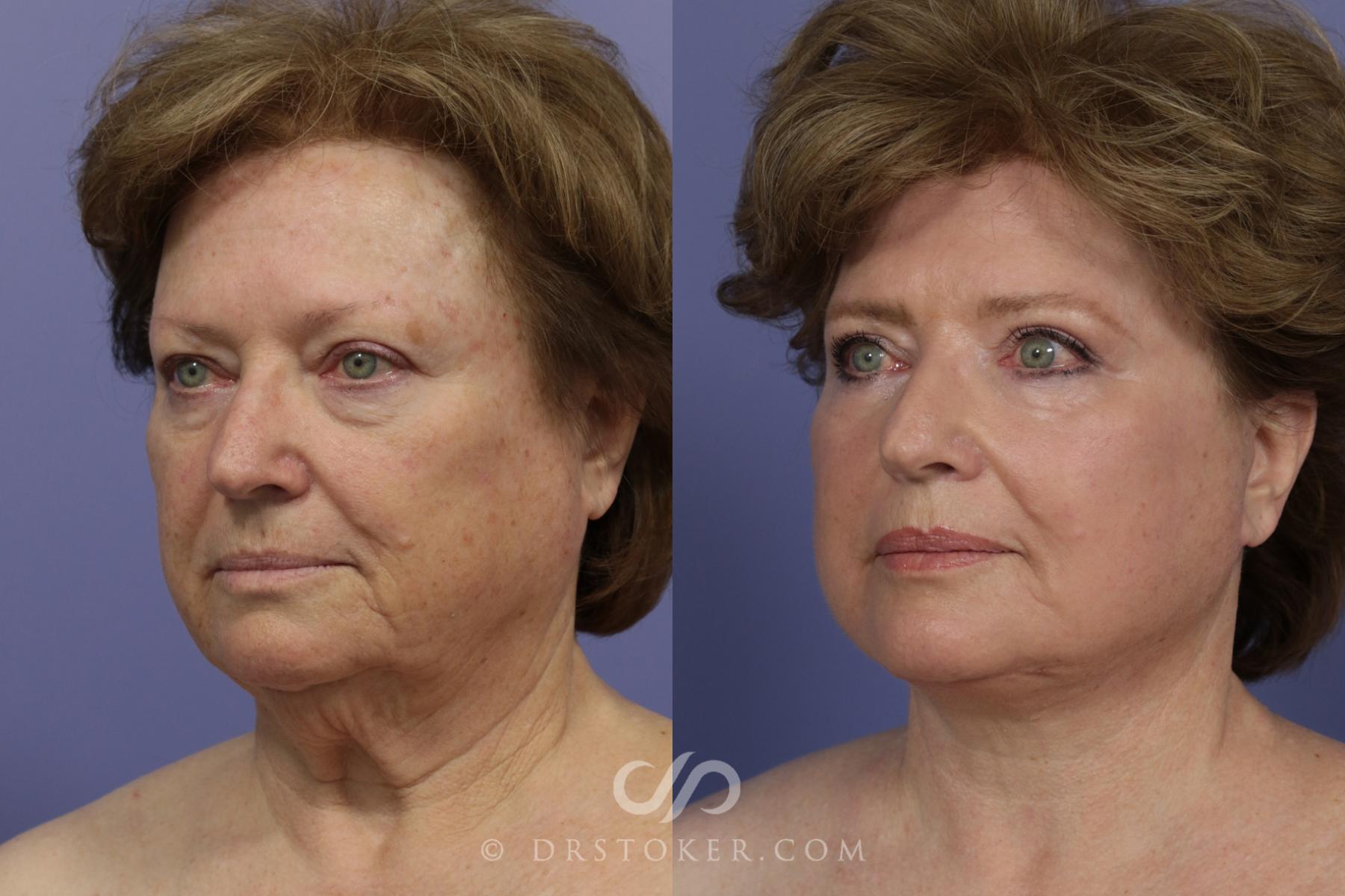 Before & After Facelift - Traceless Facelift Case 817 View #2 View in Los Angeles, CA