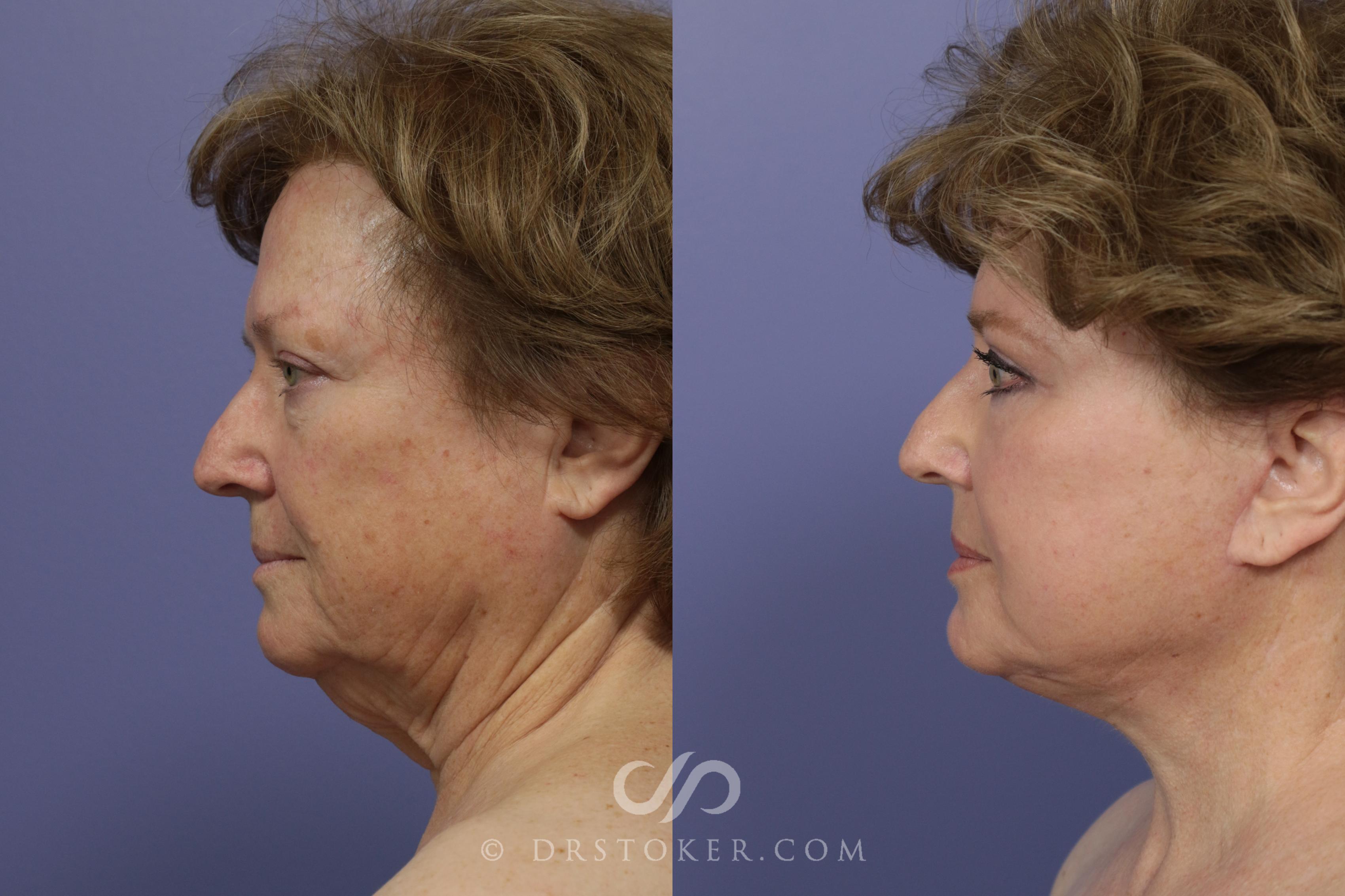 Before & After Facelift - Traceless Facelift Case 817 View #3 View in Los Angeles, CA