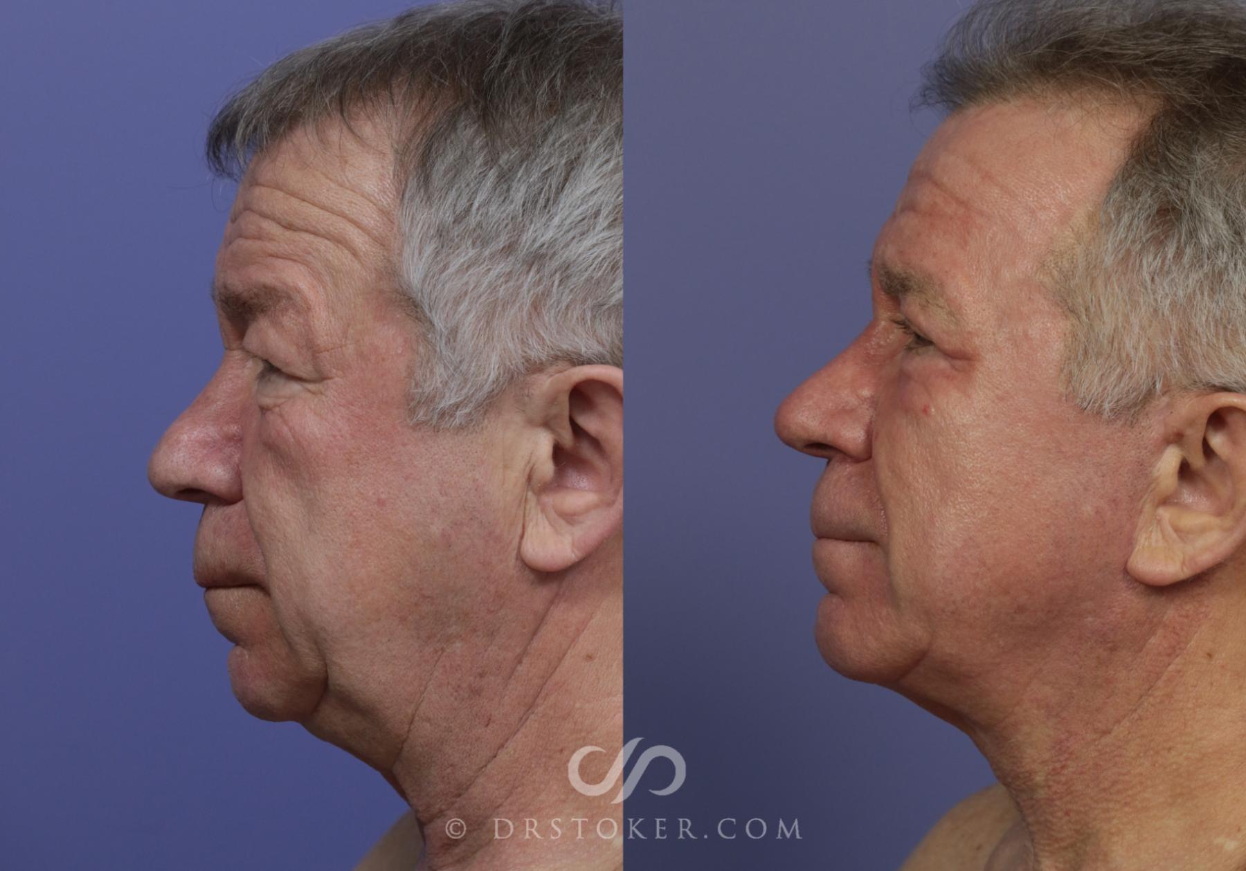 Before & After Neck Lift - Traceless Neck Lift  Case 823 View #3 View in Los Angeles, CA
