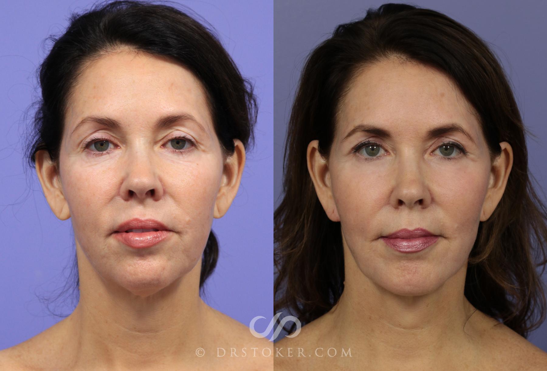 Before & After Facelift - Traceless Facelift Case 827 View #1 View in Los Angeles, CA