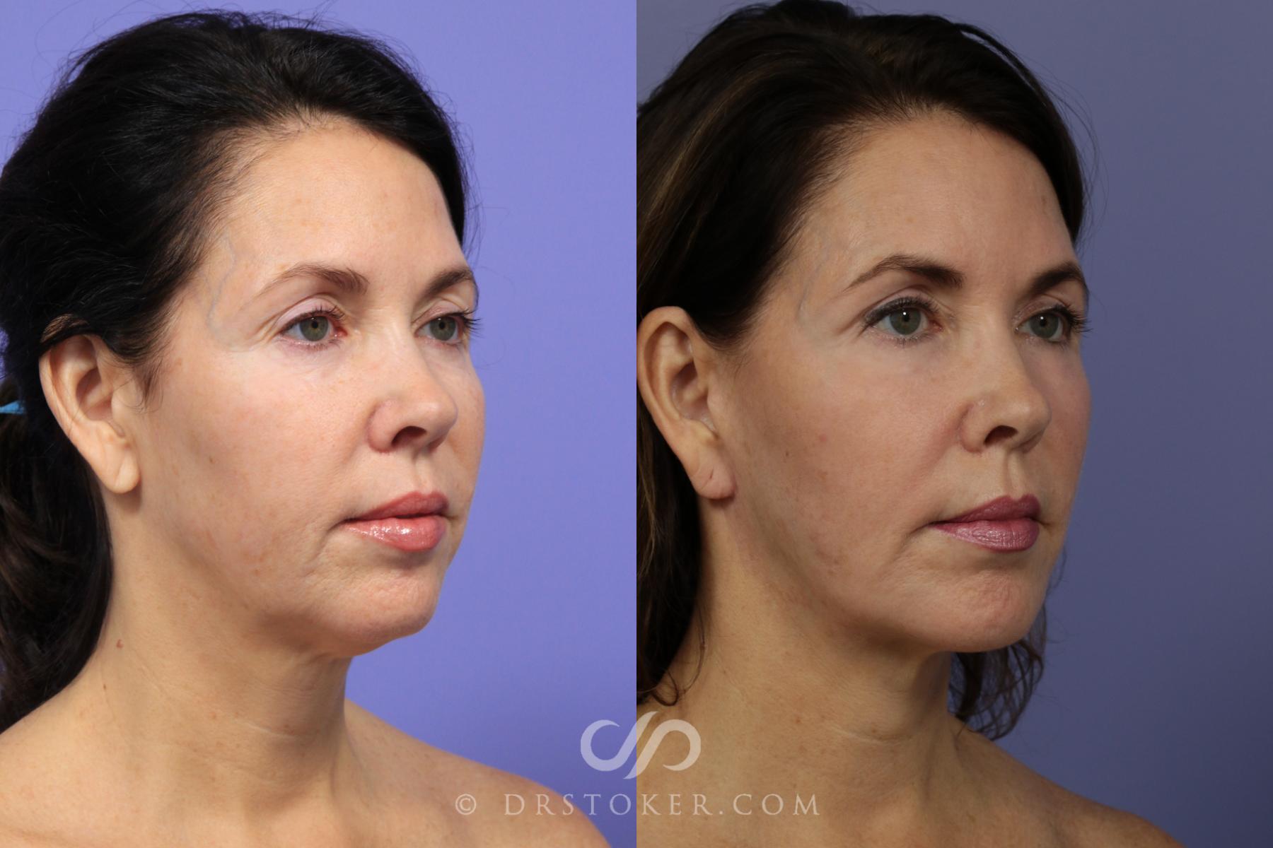 Before & After Facelift - Traceless Facelift Case 827 View #3 View in Los Angeles, CA