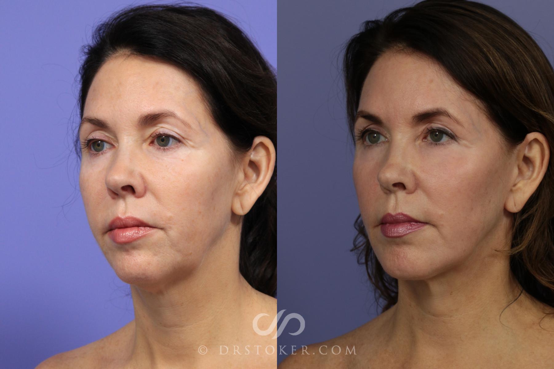 Before & After Facelift - Traceless Facelift Case 827 View #4 View in Los Angeles, CA