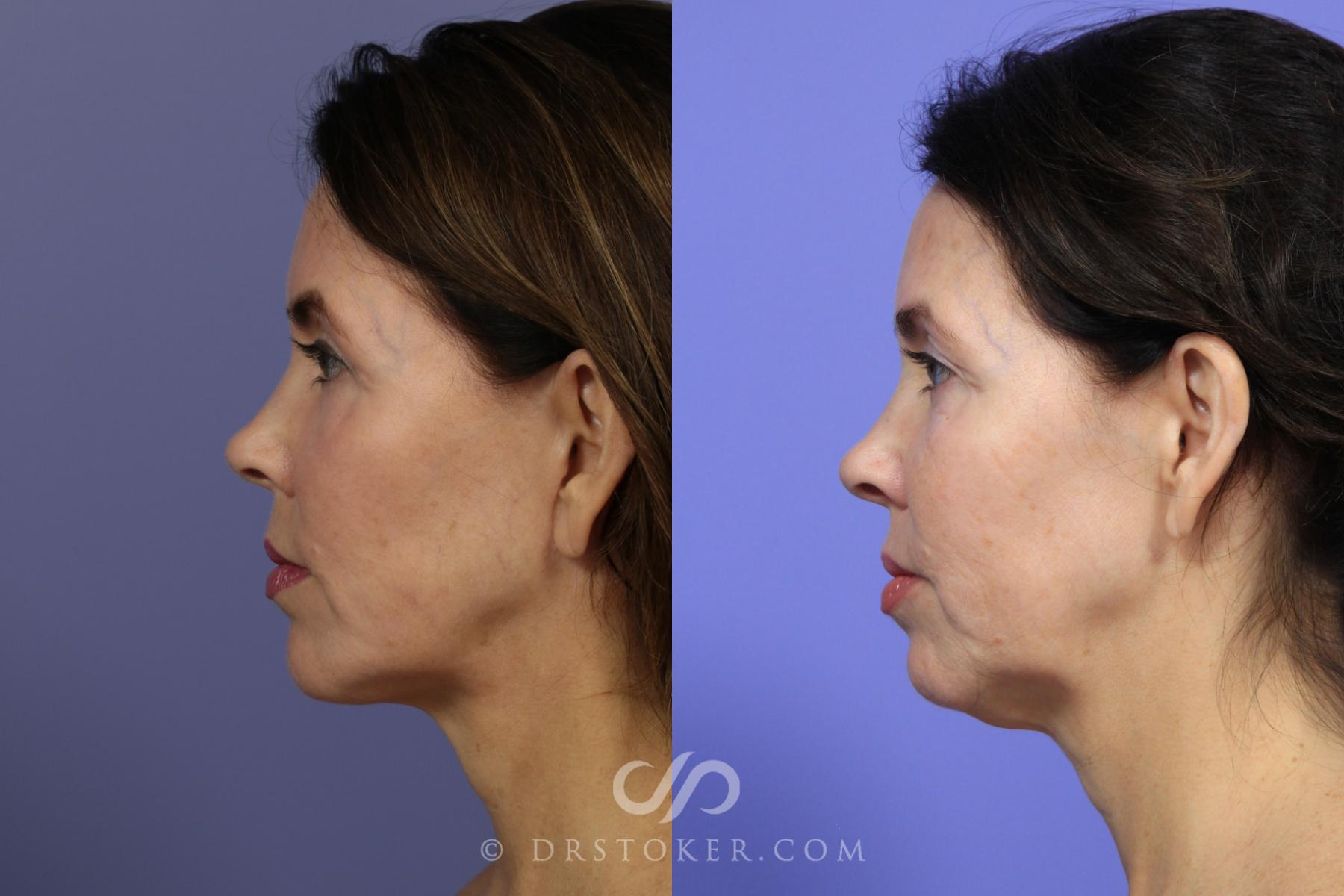 Before & After Facelift - Traceless Facelift Case 827 View #5 View in Los Angeles, CA
