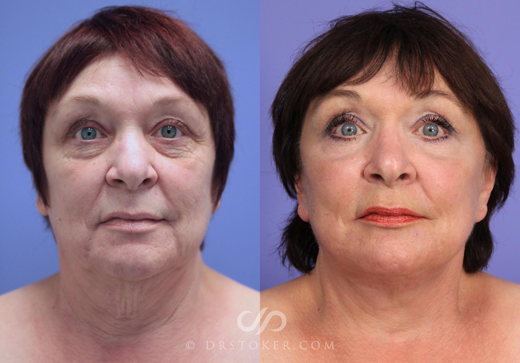 Before & After Facelift - Traceless Facelift Case 828 View #1 View in Los Angeles, CA