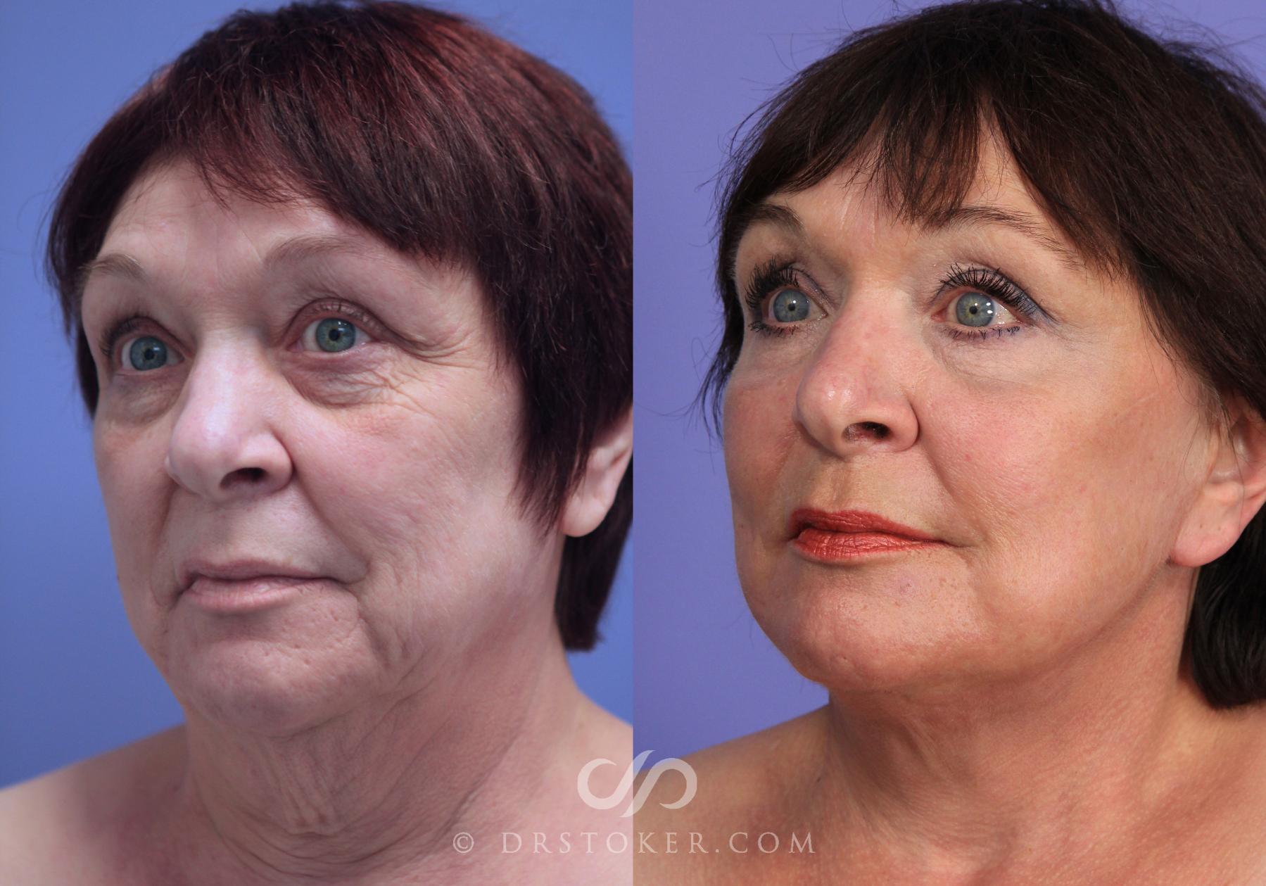 Before & After Facelift - Traceless Facelift Case 828 View #2 View in Los Angeles, CA