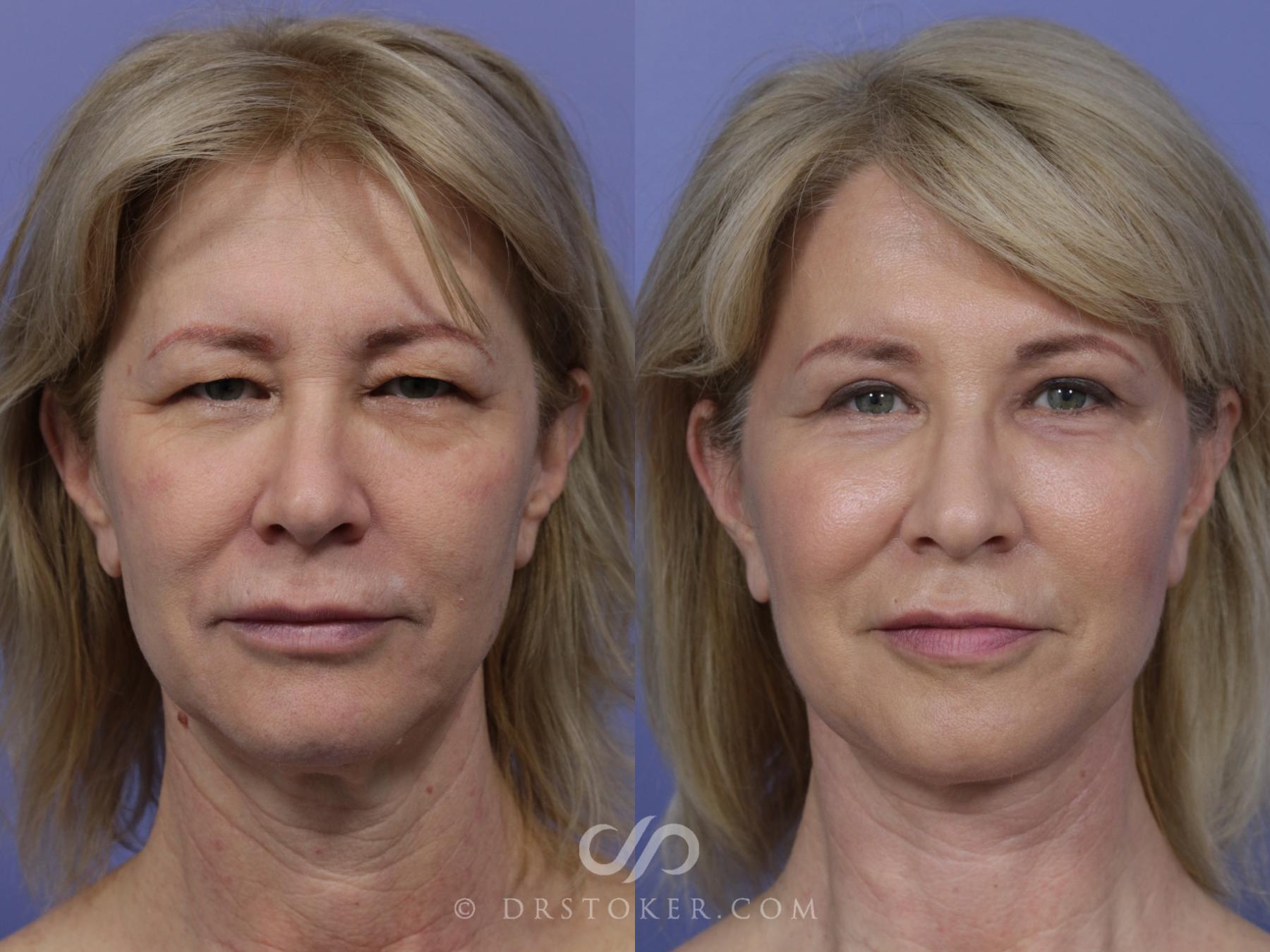 Before & After Facelift - Traceless Facelift Case 830 View #1 View in Los Angeles, CA