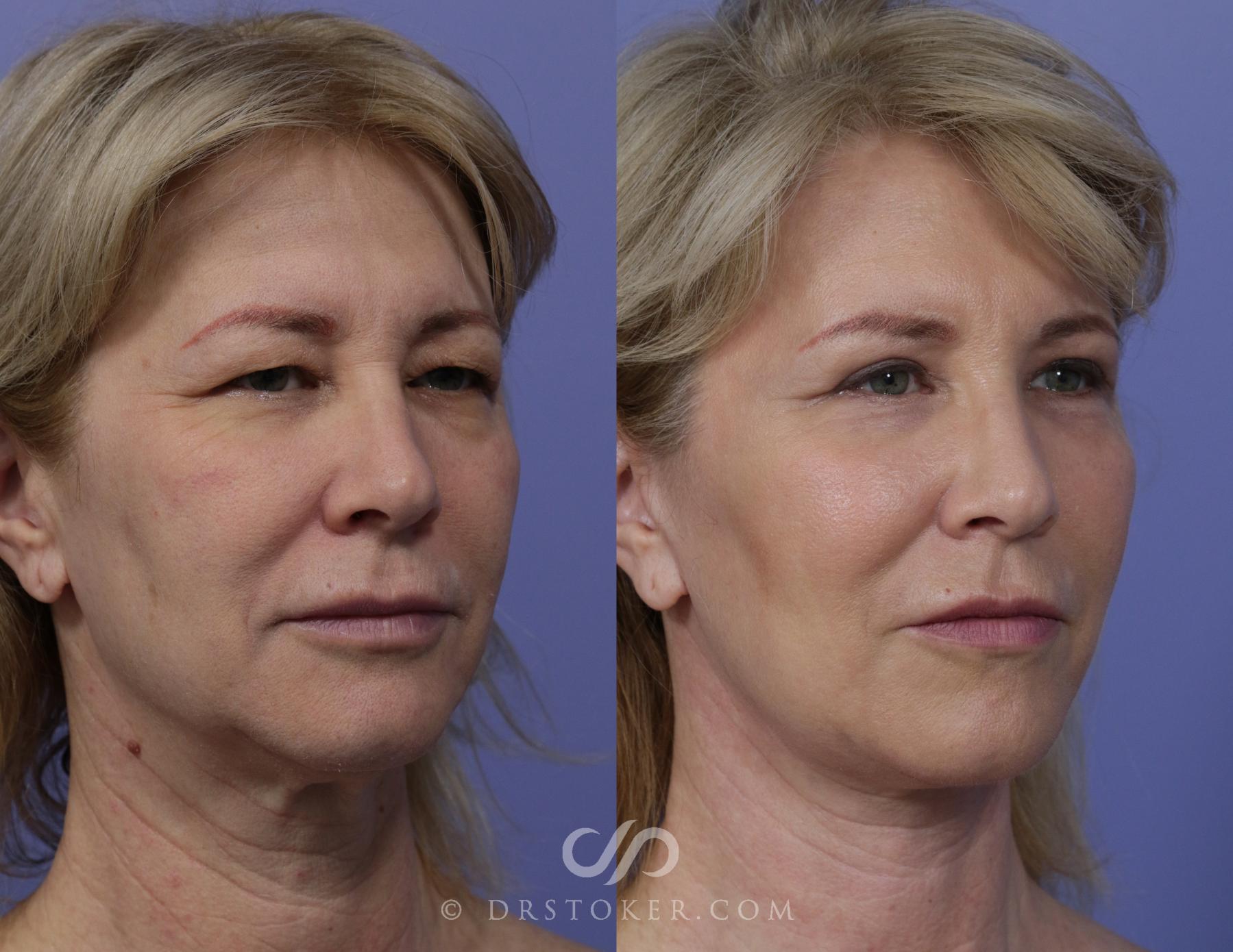 Before & After Facelift - Traceless Facelift Case 830 View #2 View in Los Angeles, CA