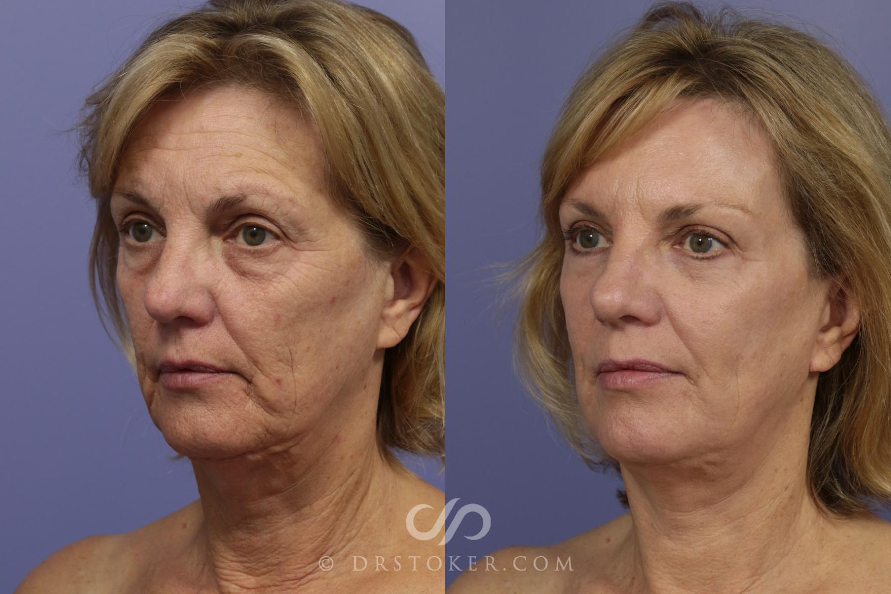 Before & After Facelift - Traceless Facelift Case 831 View #2 View in Los Angeles, CA