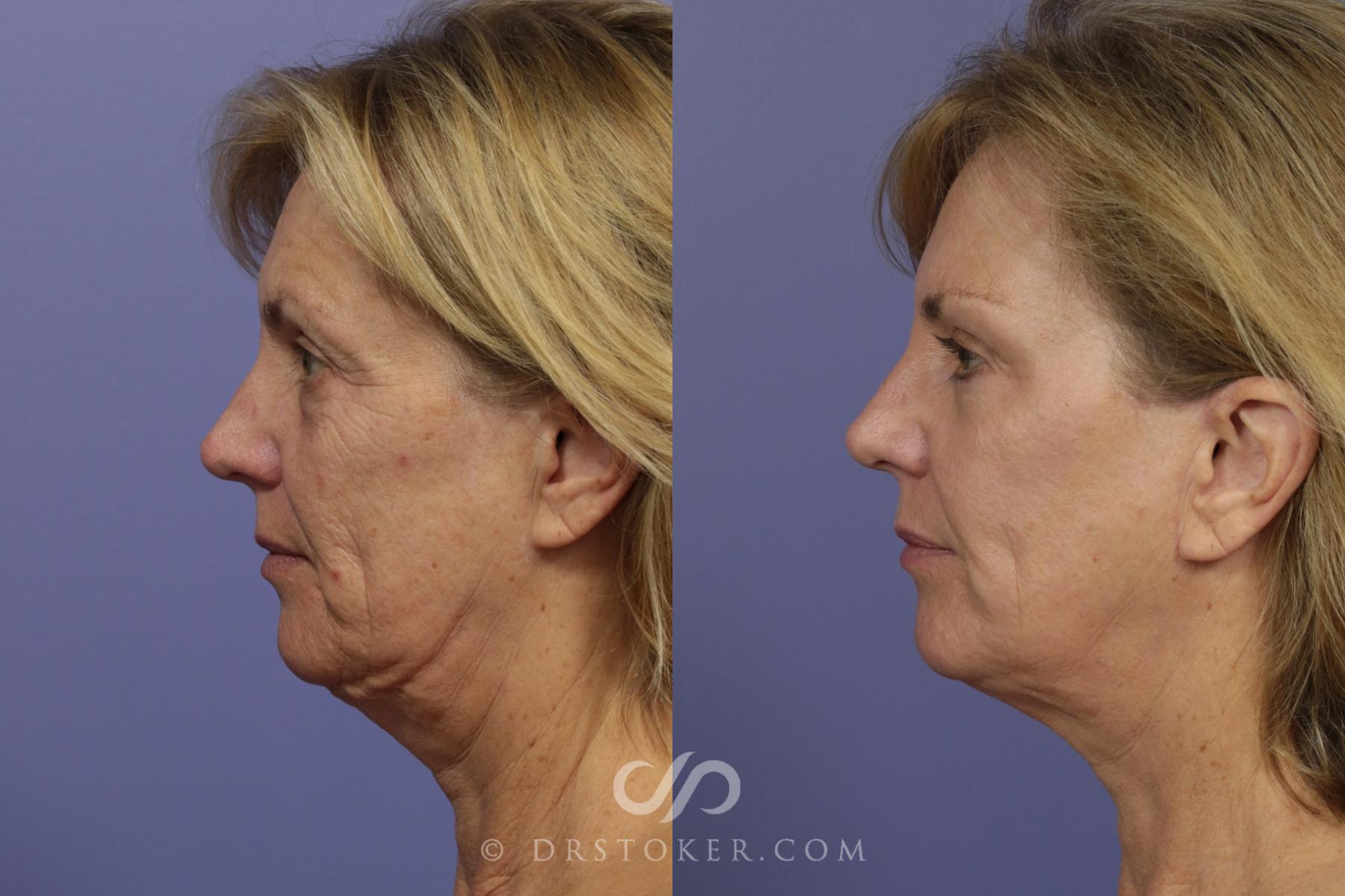 Before & After Facelift - Traceless Facelift Case 831 View #3 View in Los Angeles, CA