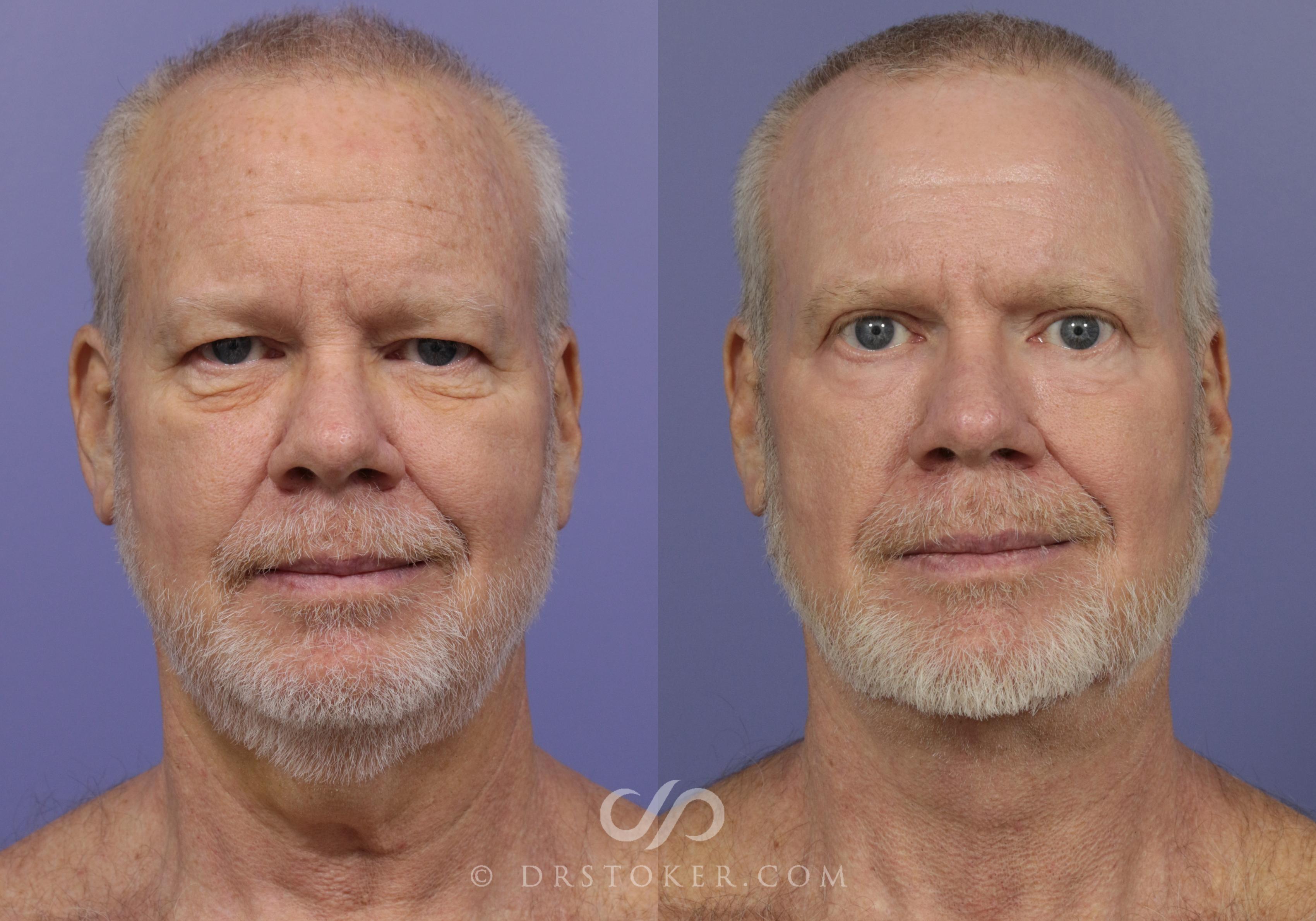 Before & After Facelift - Traceless Facelift Case 833 View #1 View in Los Angeles, CA