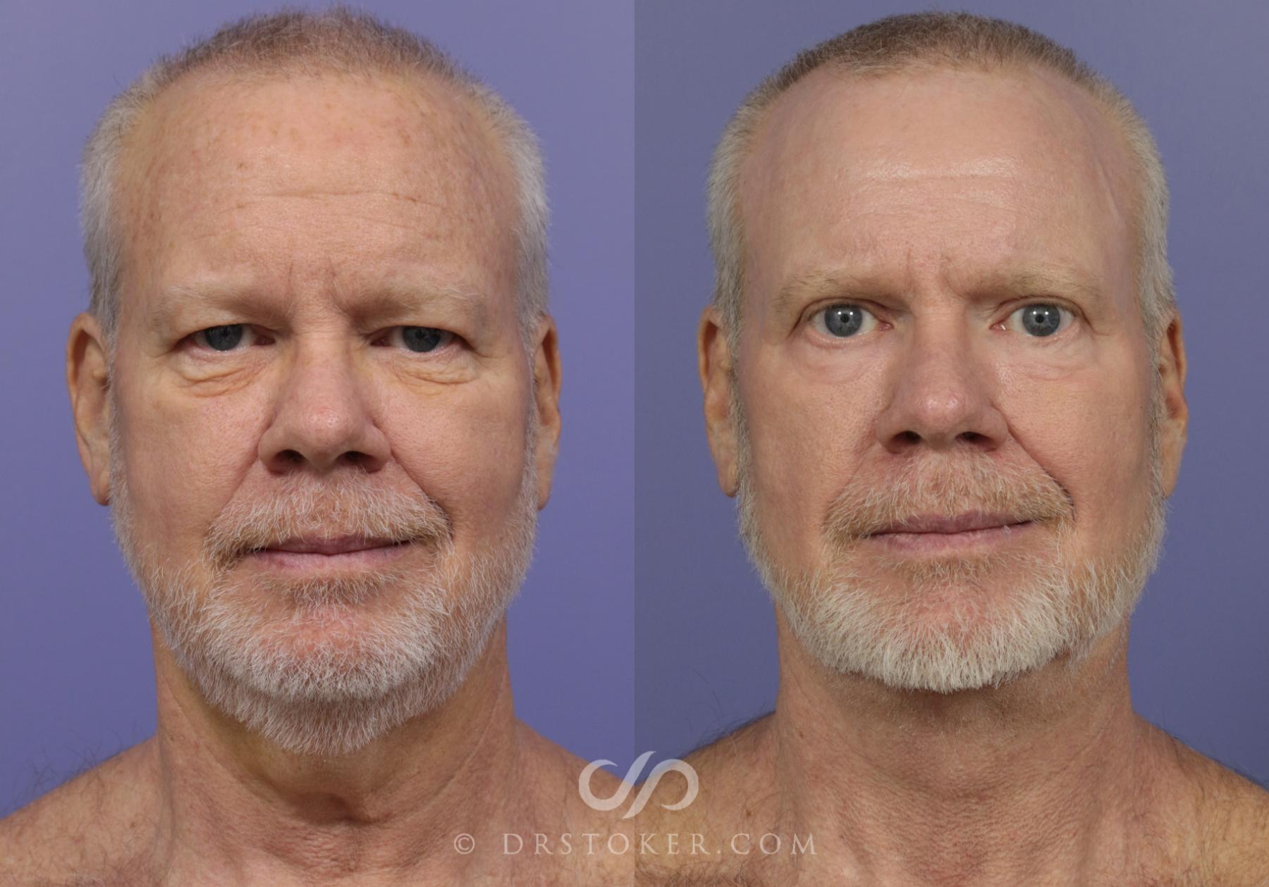 Before & After Neck Lift for Men Case 833 View #1 View in Los Angeles, CA