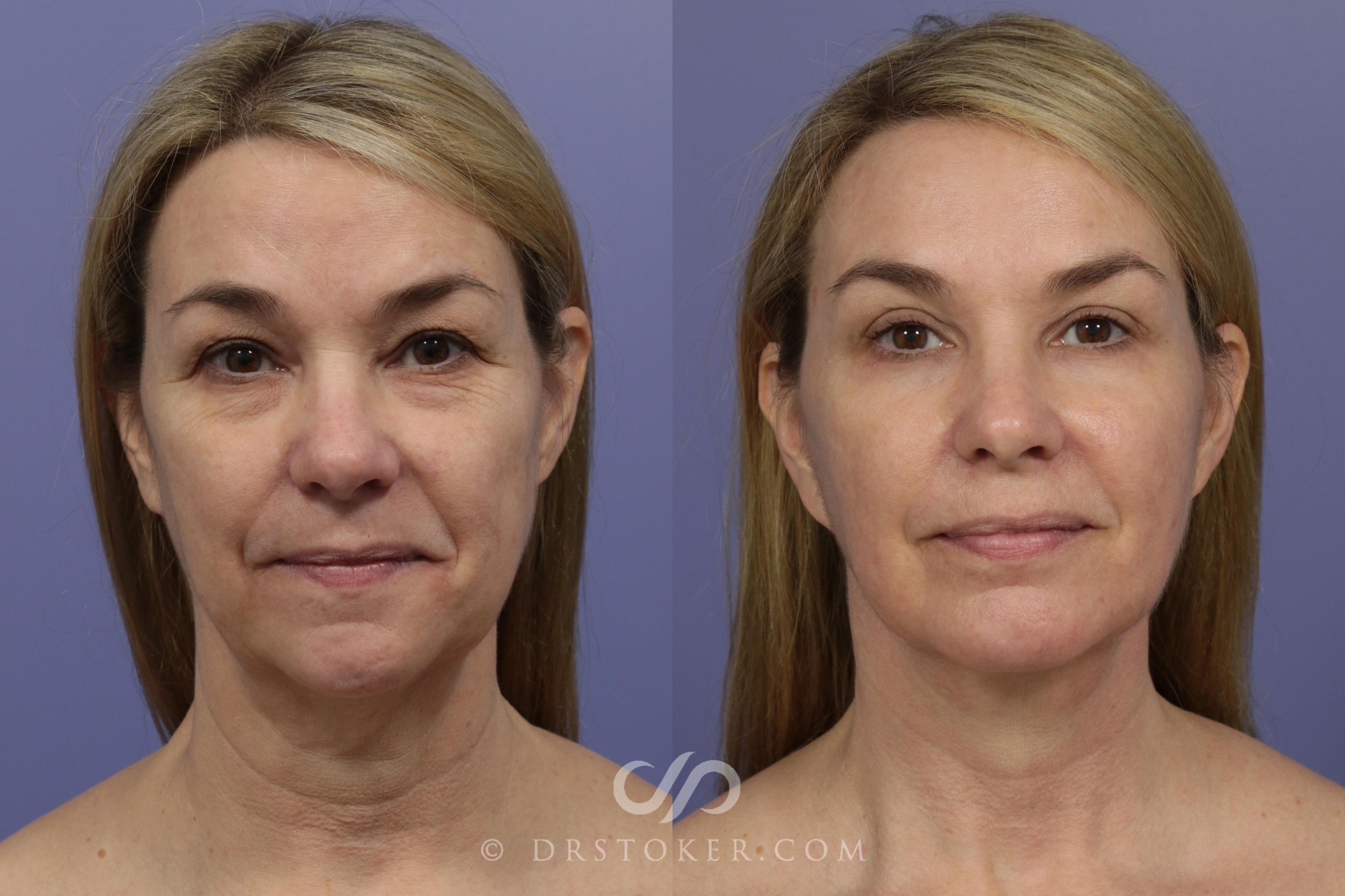 Before & After Facelift - Traceless Facelift Case 836 View #1 View in Marina del Rey, CA