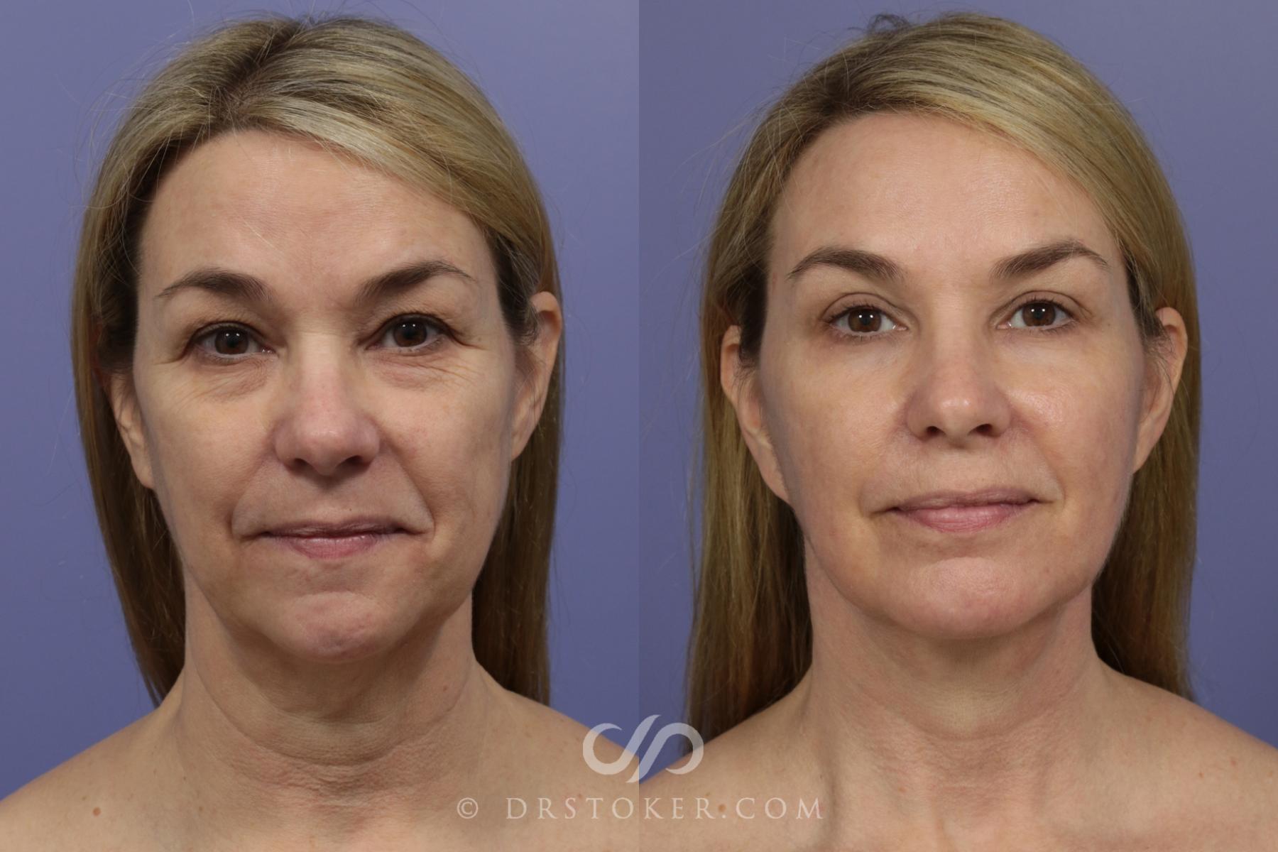 Before & After Facelift - Traceless Facelift Case 836 View #1 View in Los Angeles, CA