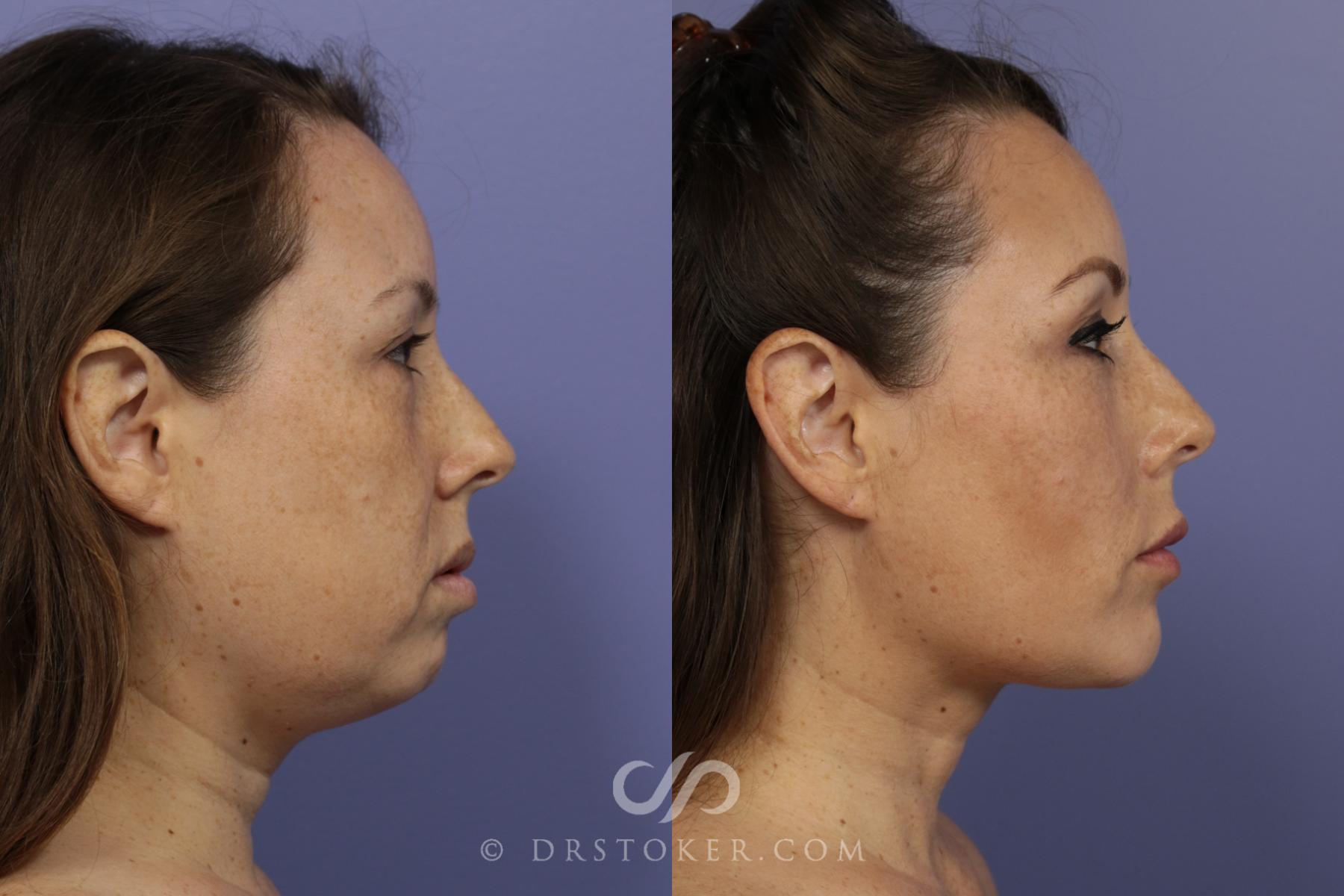 Before & After Liposuction - Neck Case 837 View #1 View in Los Angeles, CA