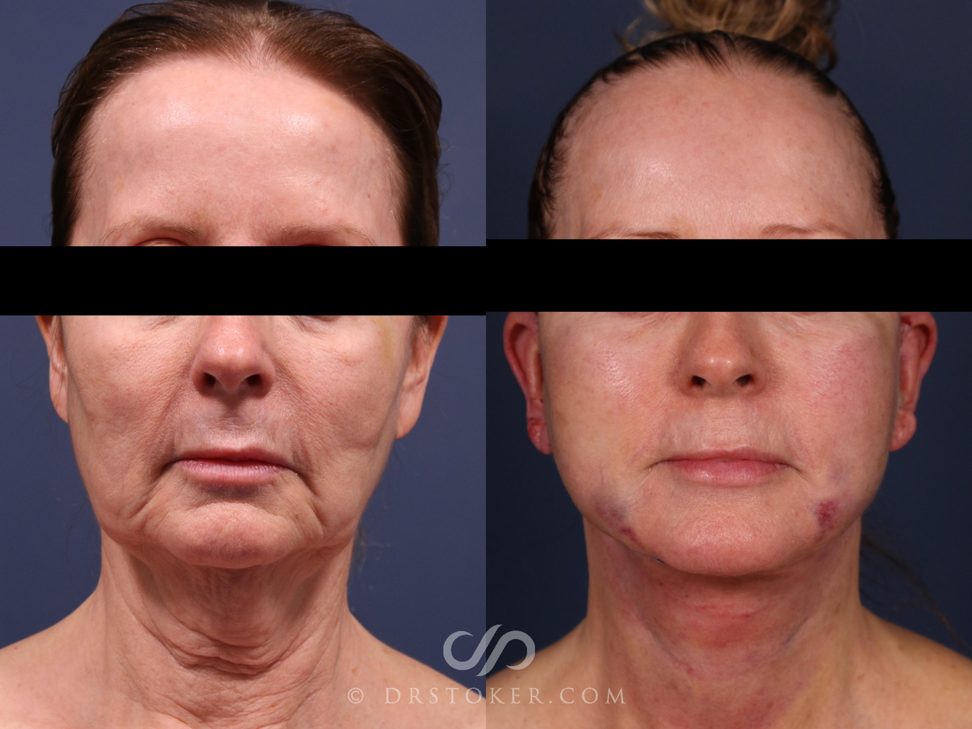 Before & After Facelift/Neck Lift (Deep Plane/Traceless) Case 2308 1 Day Post-op View in Los Angeles, CA