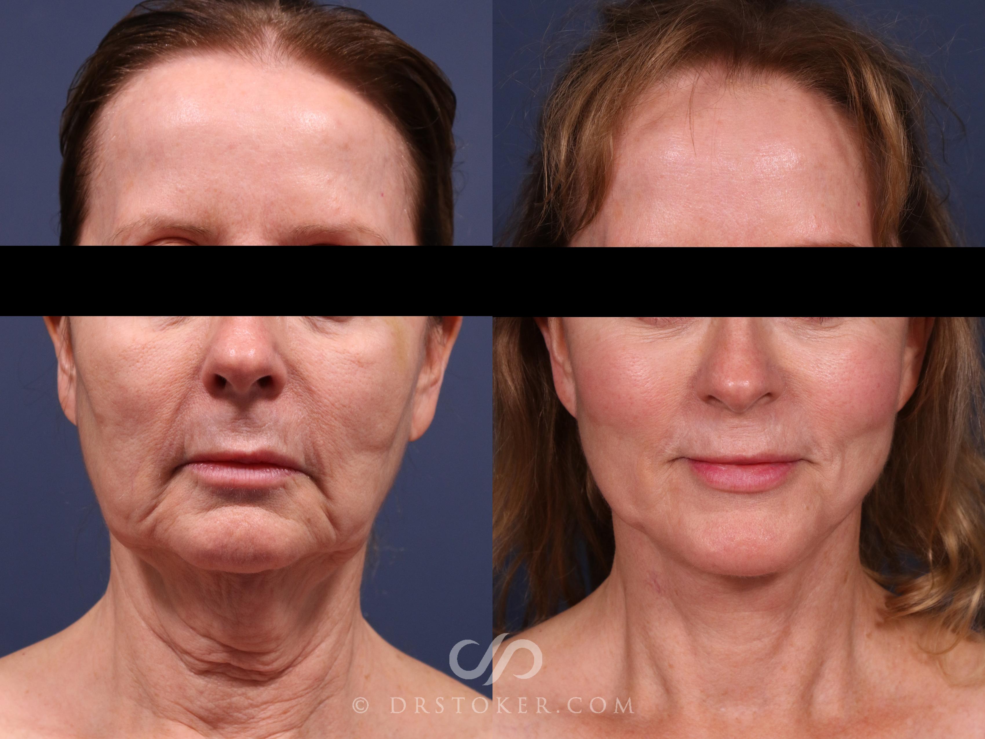 Before & After Facelift/Neck Lift (Deep Plane/Traceless) Case 2308 Front View in Los Angeles, CA