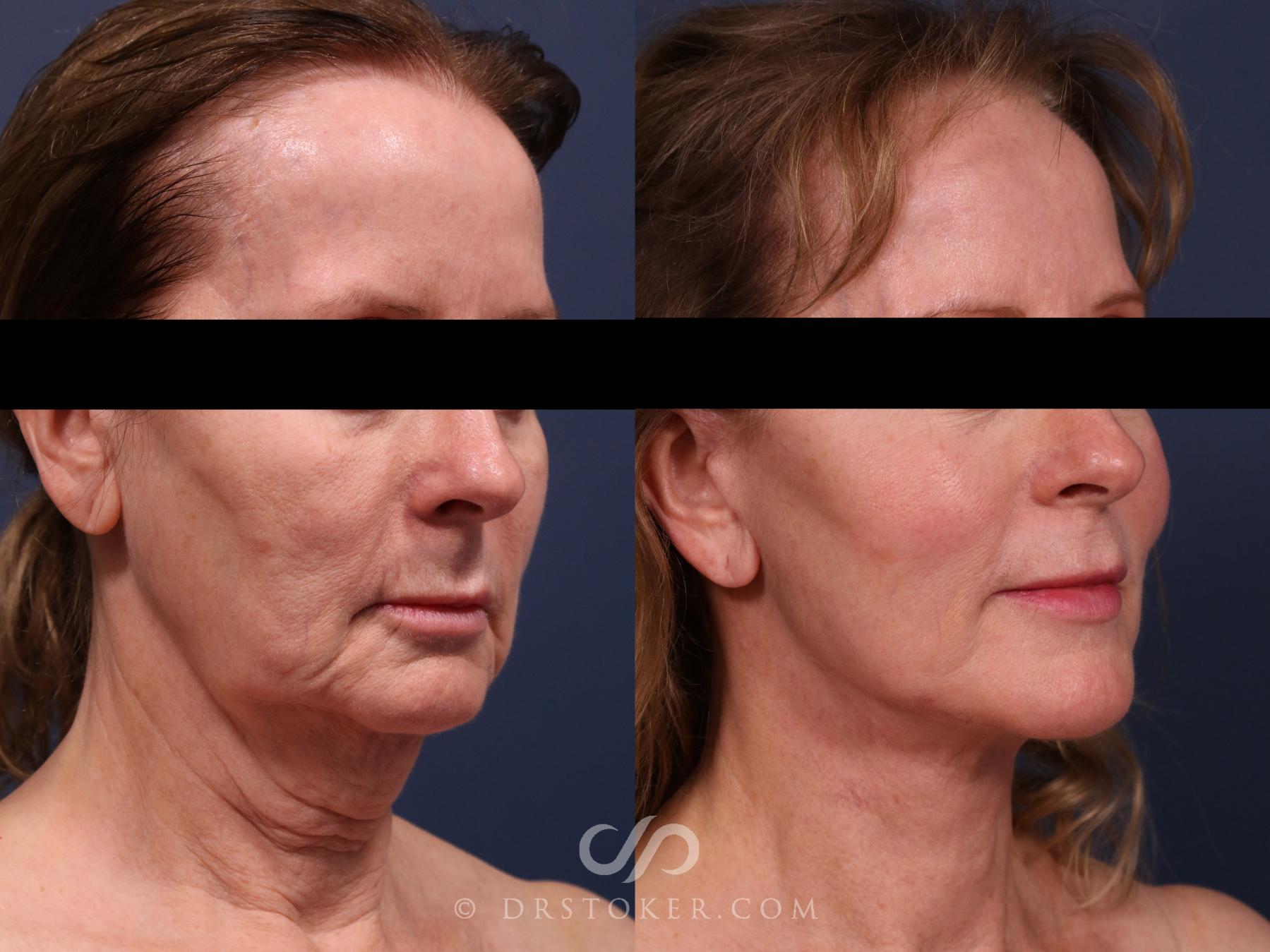 Before & After Facelift/Neck Lift (Deep Plane/Traceless) Case 2308 Right Oblique View in Los Angeles, CA