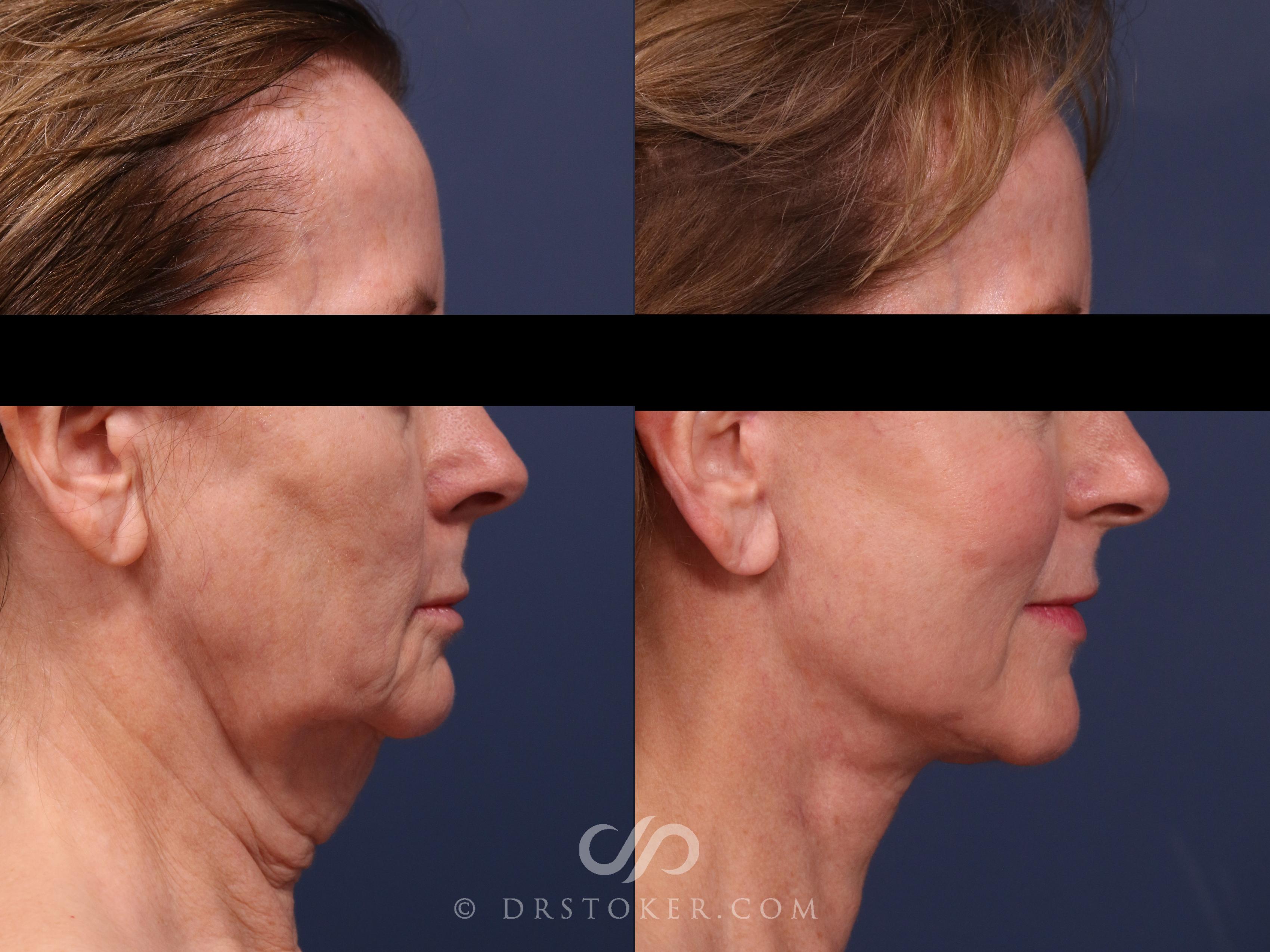 Before & After Facelift/Neck Lift (Deep Plane/Traceless) Case 2308 Right Side View in Los Angeles, CA