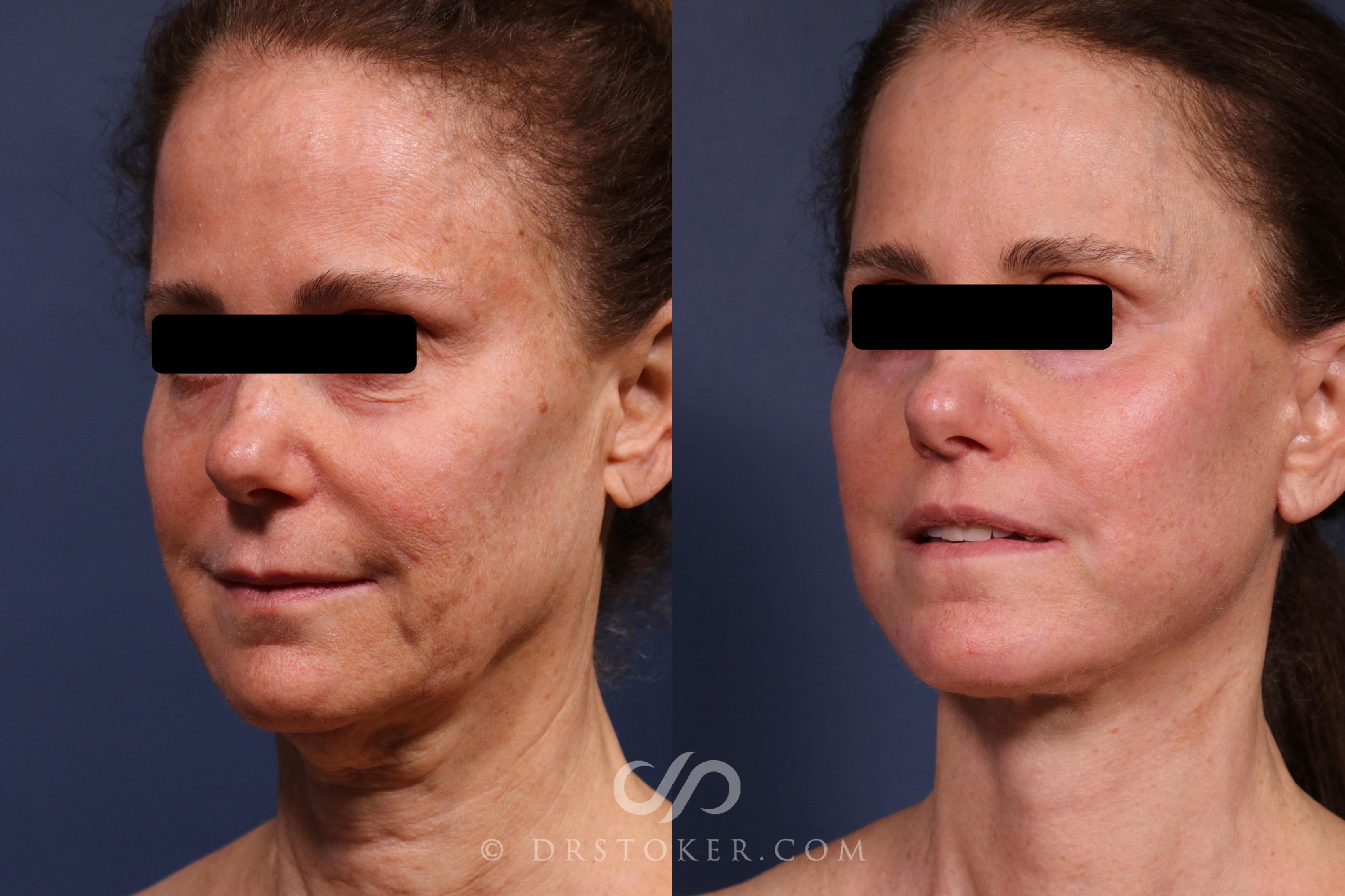 Before & After Facelift/Neck Lift (Deep Plane/Traceless) Case 2373 Left Oblique View in Los Angeles, CA