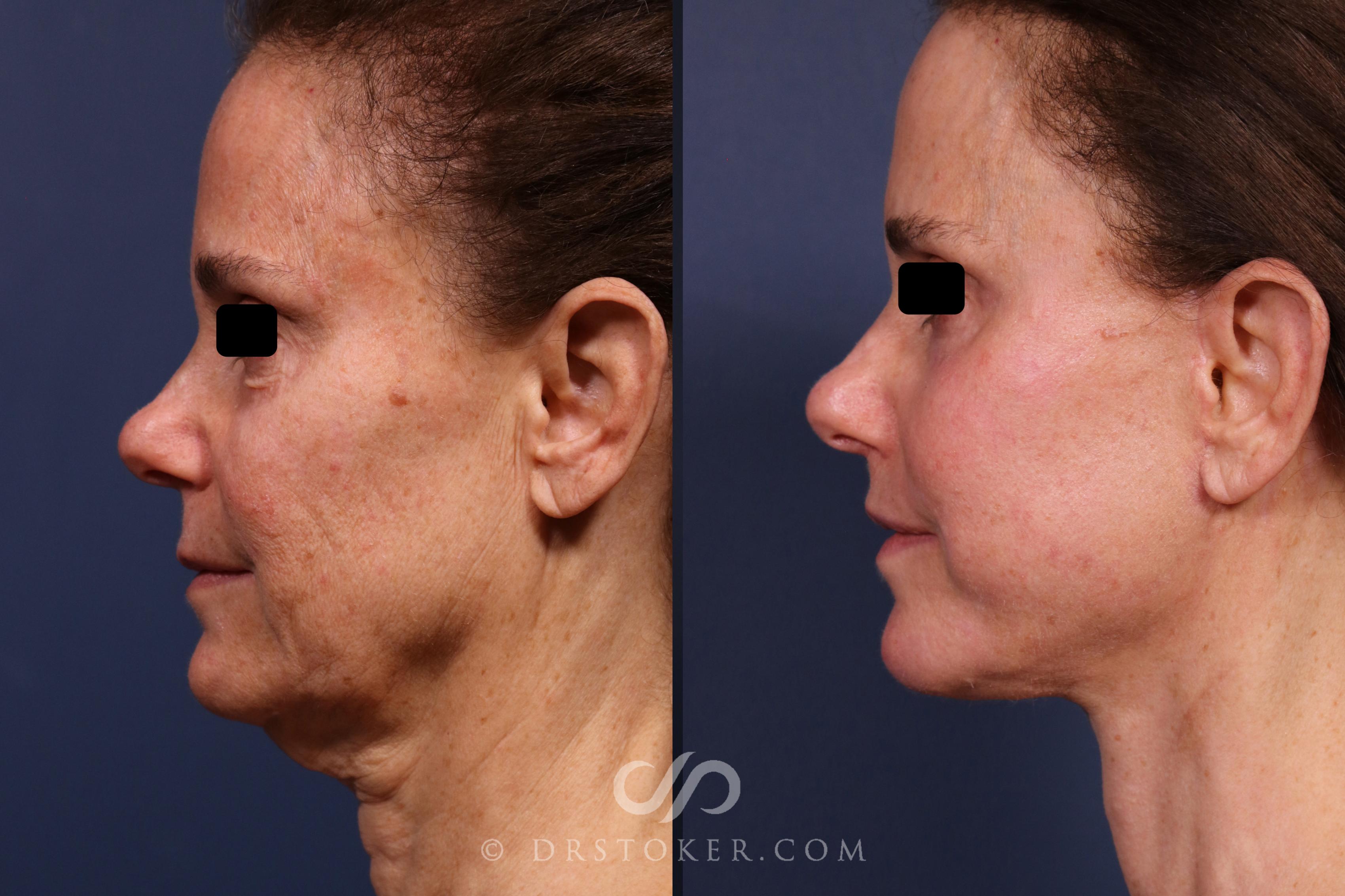 Before & After Facelift/Neck Lift (Deep Plane/Traceless) Case 2373 Left Side View in Los Angeles, CA