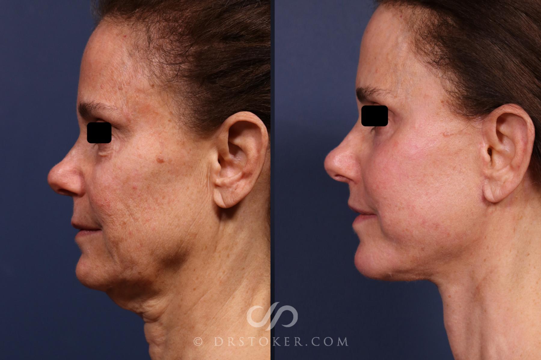 Before & After Facelift/Neck Lift (Deep Plane/Traceless) Case 2373 Left Side View in Los Angeles, CA