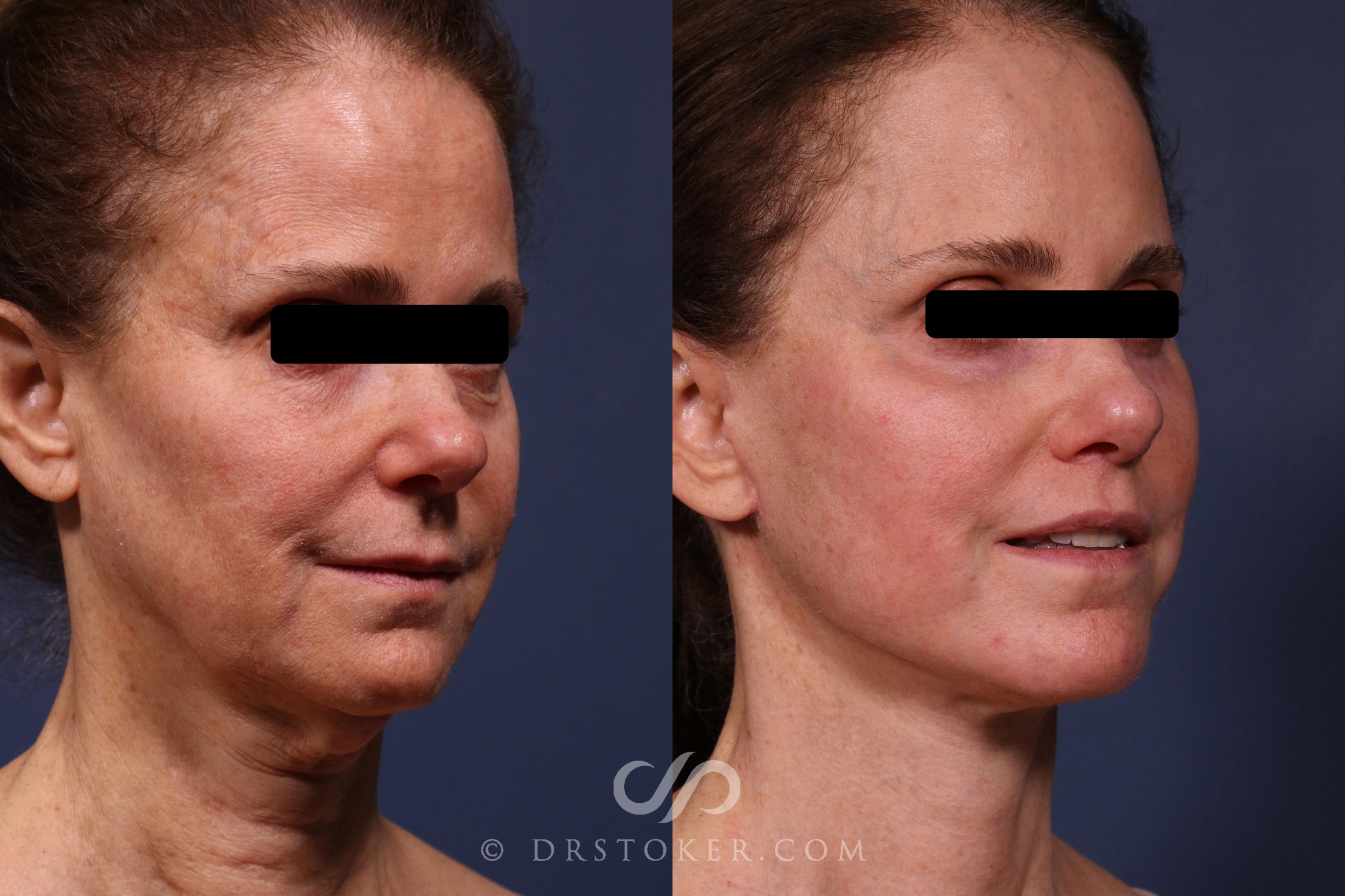 Before & After Facelift/Neck Lift (Deep Plane/Traceless) Case 2373 Right Oblique View in Los Angeles, CA