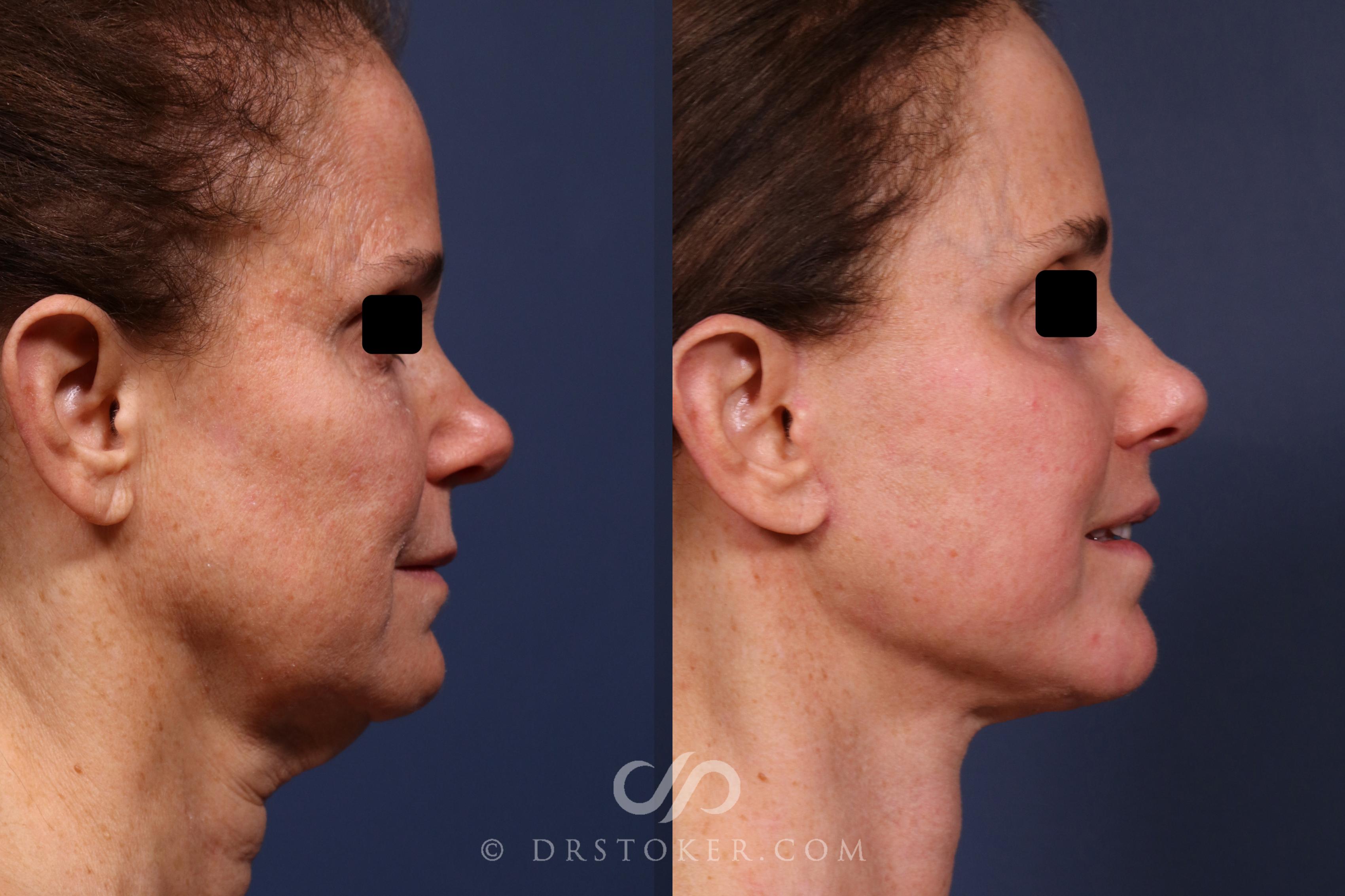 Before & After Facelift/Neck Lift (Deep Plane/Traceless) Case 2373 Right Side View in Los Angeles, CA