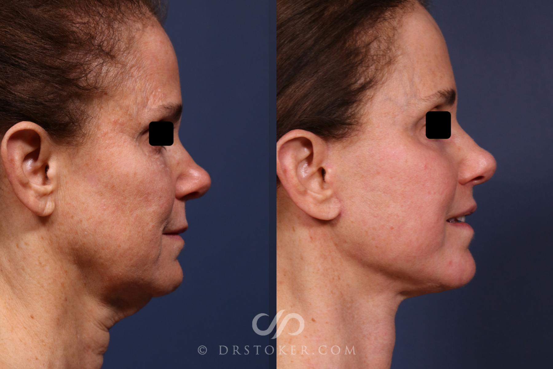 Before & After Facelift/Neck Lift (Deep Plane/Traceless) Case 2373 Right Side View in Los Angeles, CA