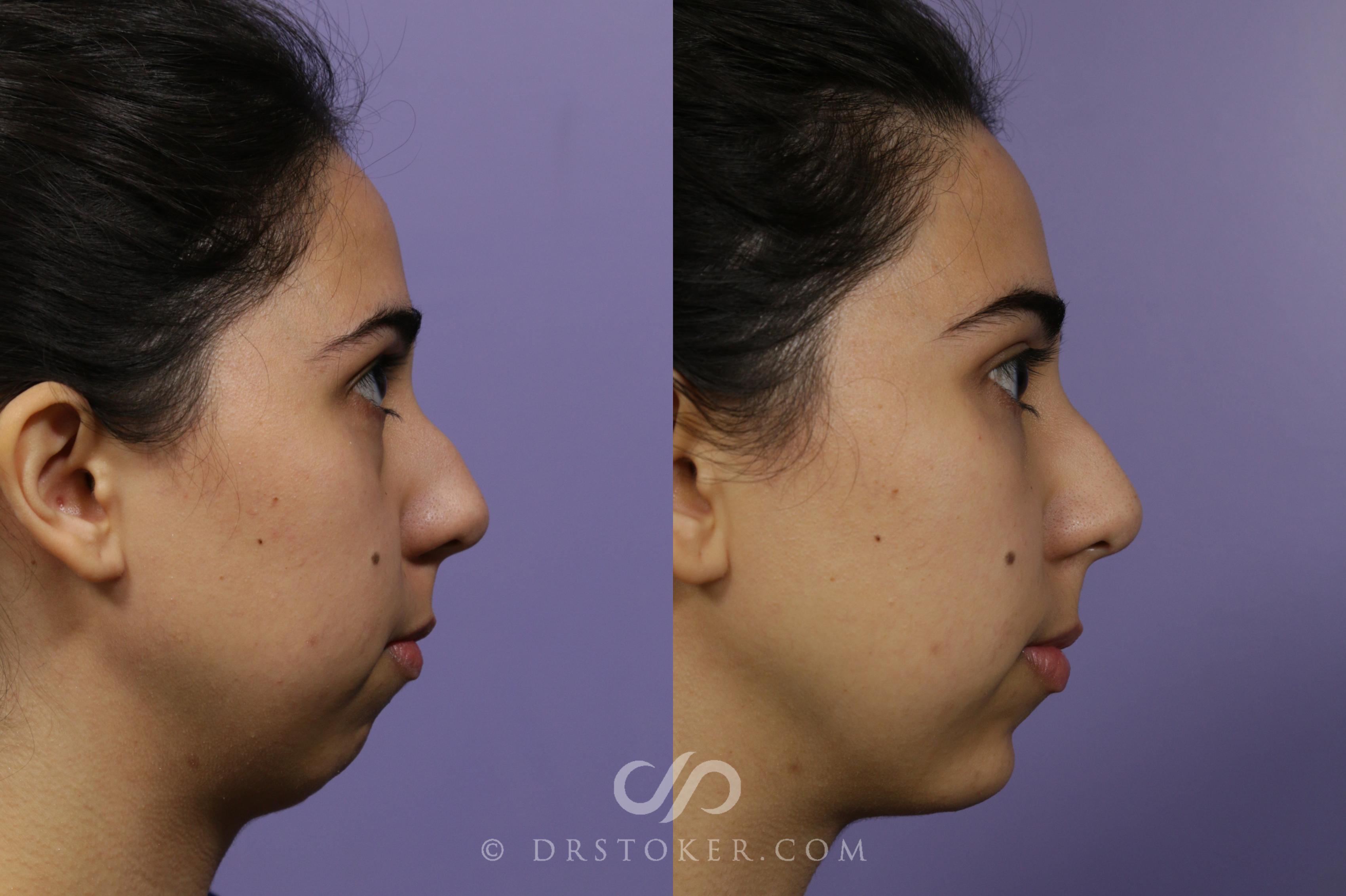 Before & After Chin Fillers/Augmentation Case 1640 View #1 View in Marina del Rey, CA