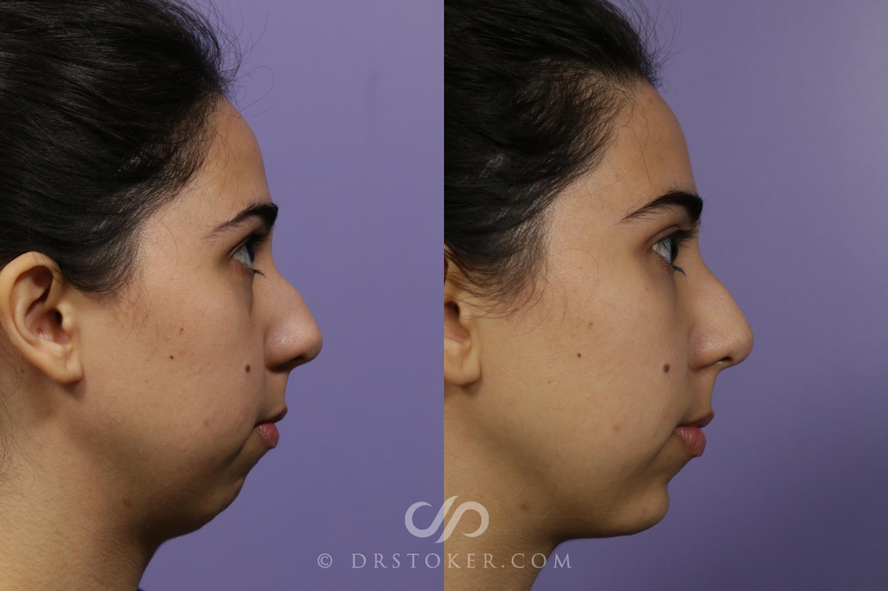 Before & After Facial Fillers Case 1640 View #1 View in Los Angeles, CA