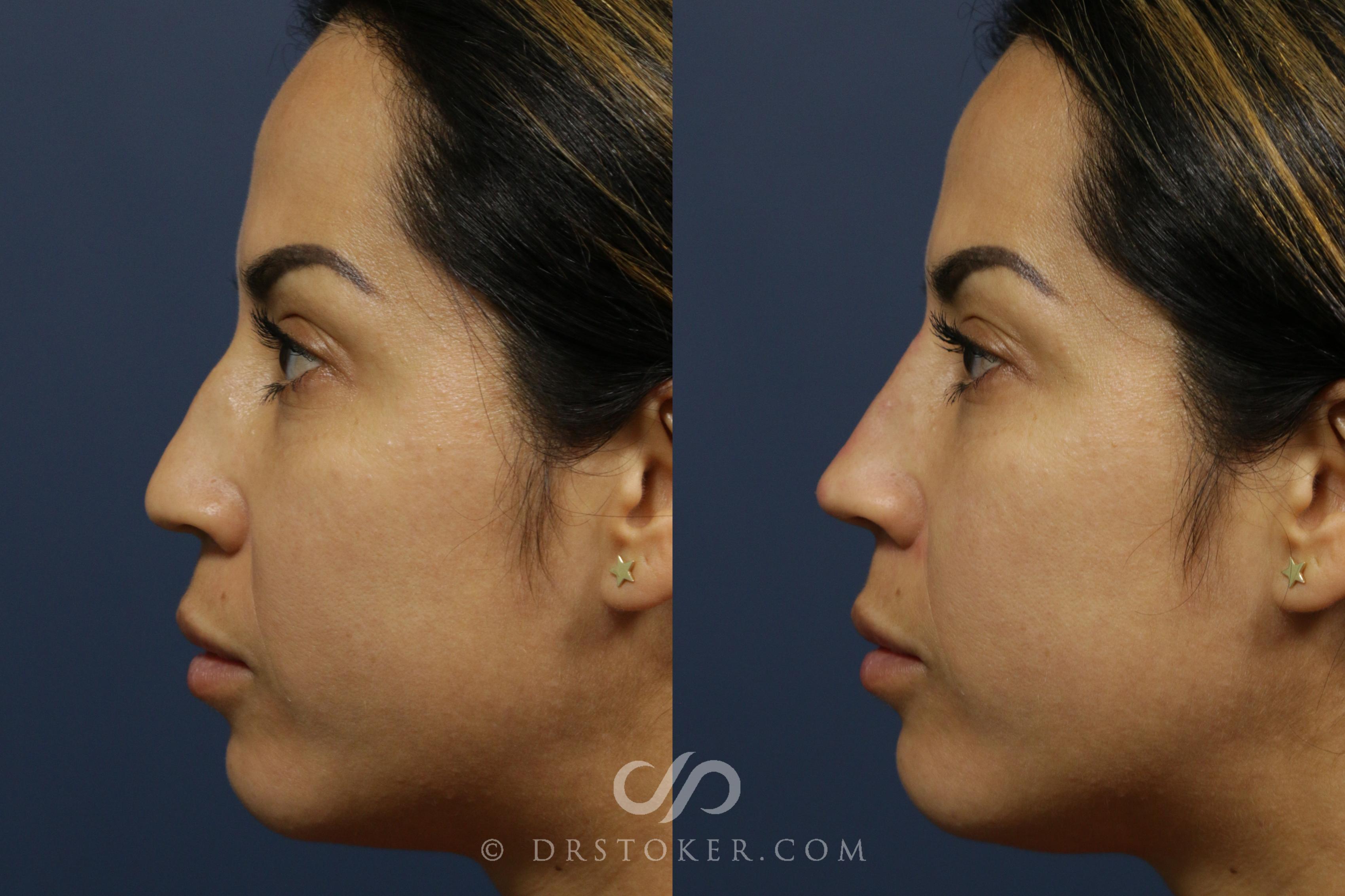 Before & After Injectables (Overview) Case 2096 Left Side View in Los Angeles, CA