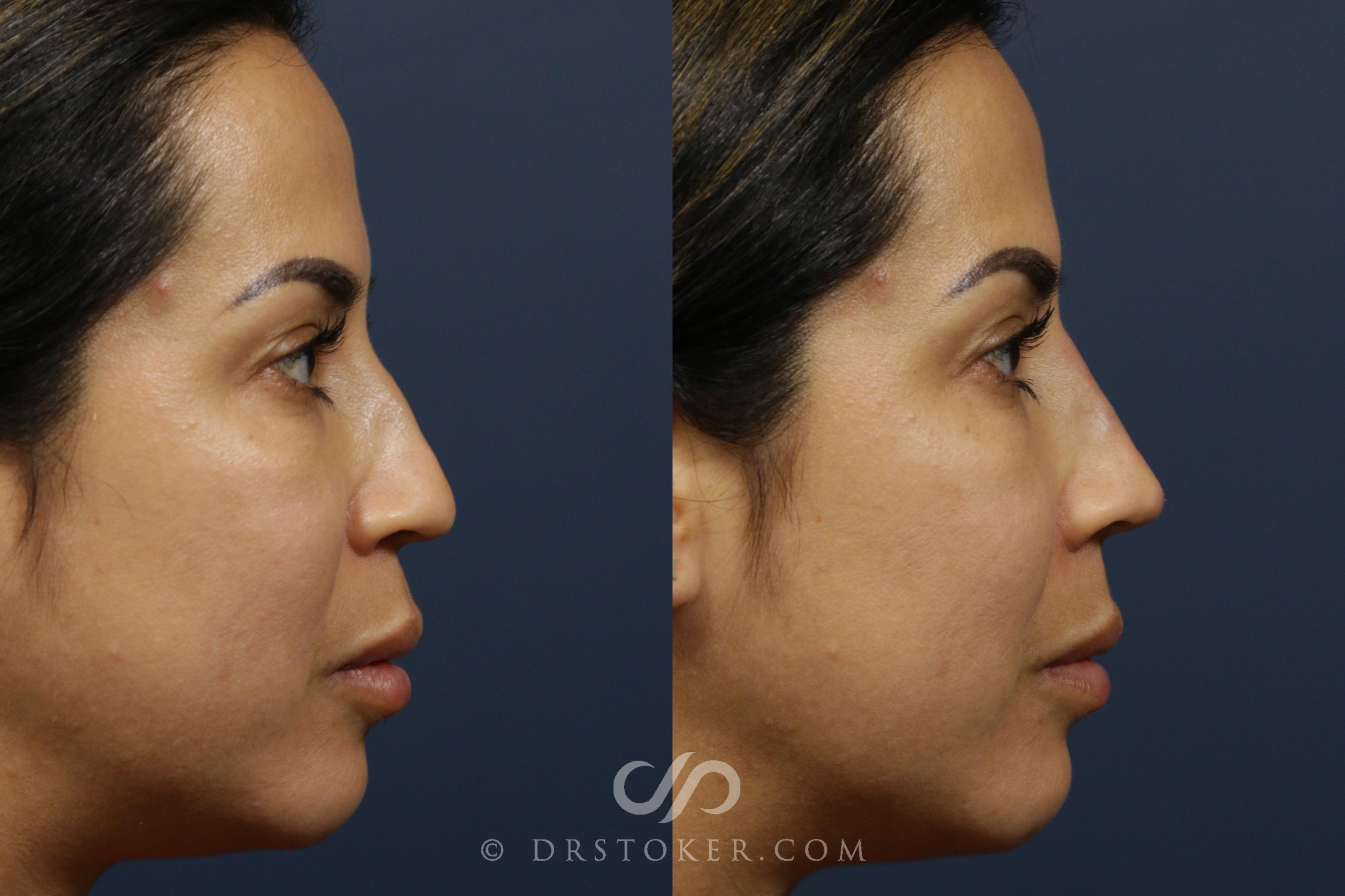 Before & After Facial Fillers Case 2096 Right Side View in Los Angeles, CA