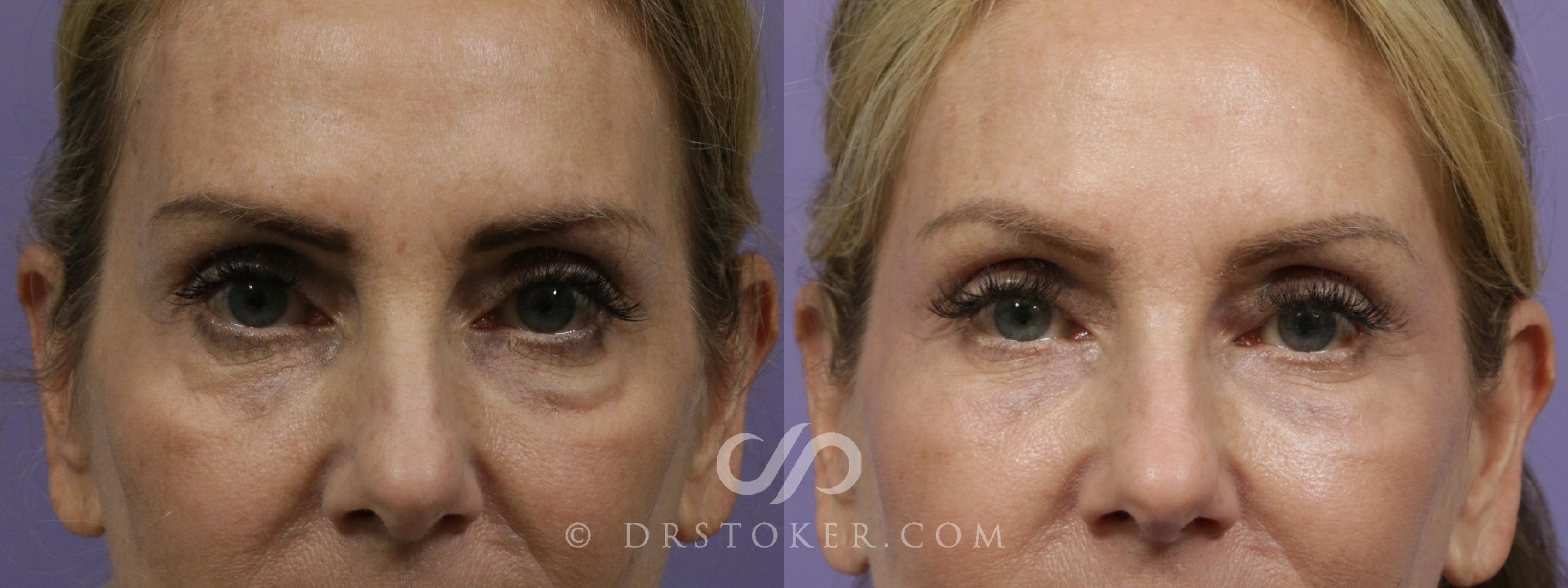 Before & After Injectables (Overview) Case 2097 Front View in Los Angeles, CA