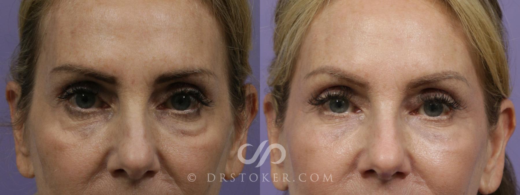 Before & After Facial Fillers Case 2097 Front View in Los Angeles, CA