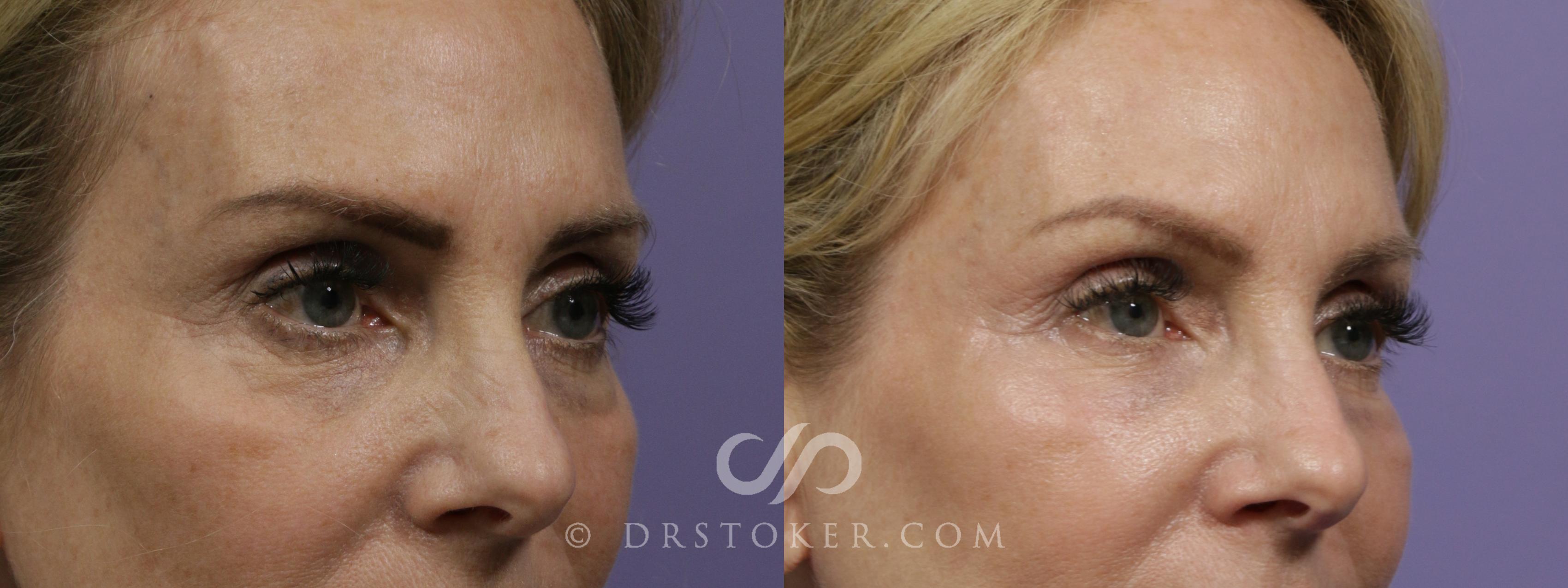 Before & After Facial Fillers Case 2097 Right Oblique View in Los Angeles, CA