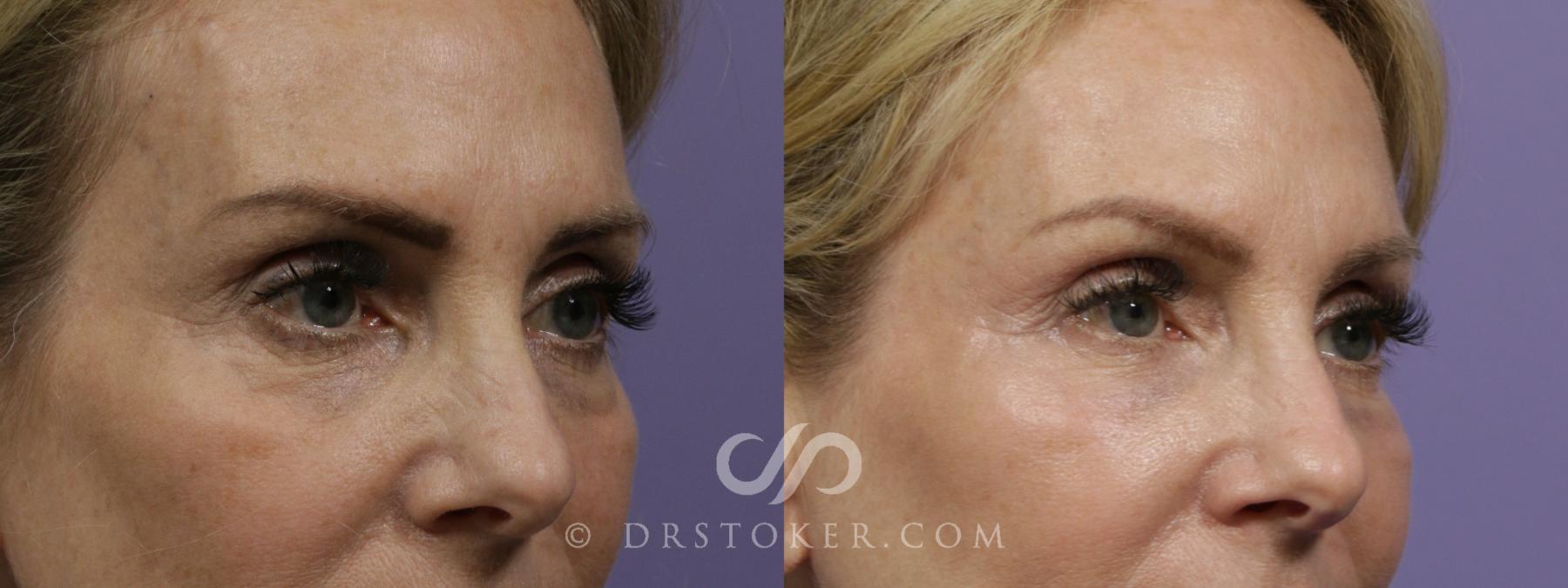 Before & After Injectables (Overview) Case 2097 Right Oblique View in Los Angeles, CA