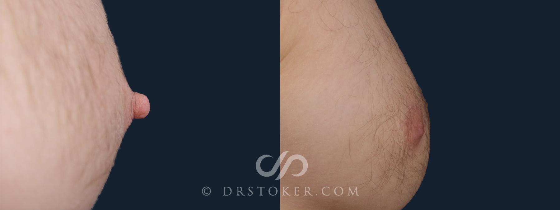 Before & After Nipple - Reduction Case 2155 Left Side View in Los Angeles, CA