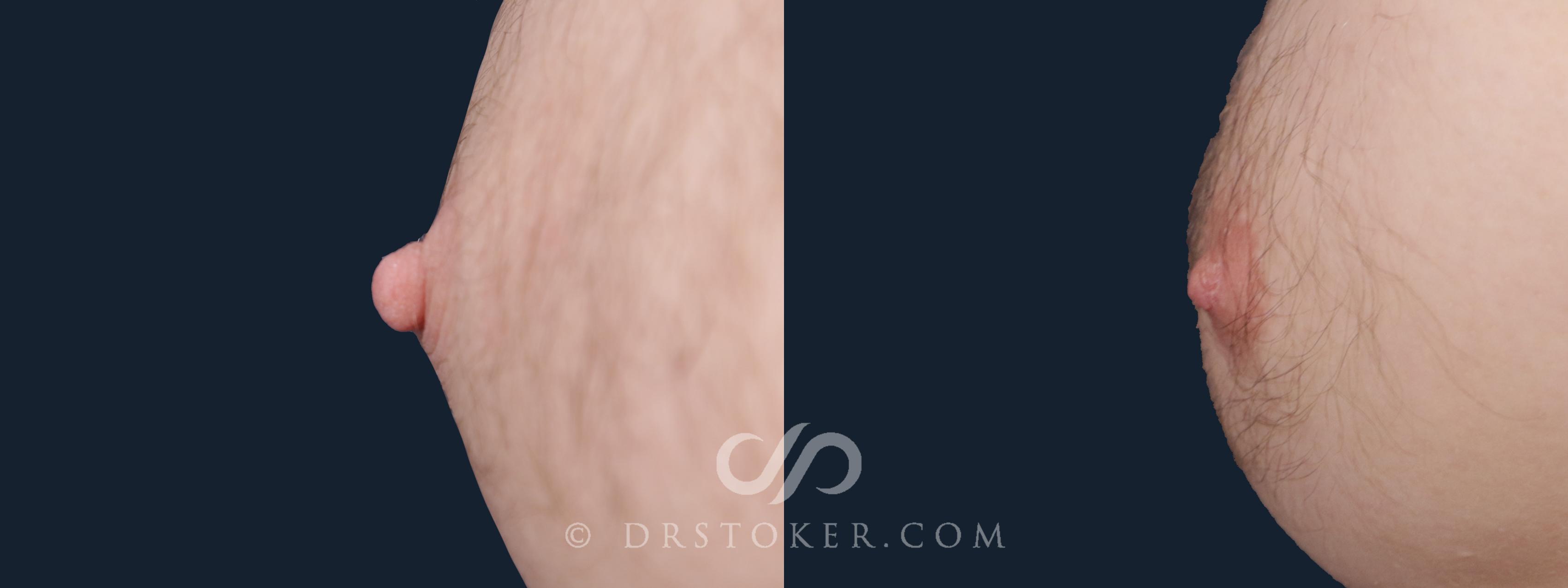 Before & After Nipple - Reduction Case 2155 Right Side View in Los Angeles, CA