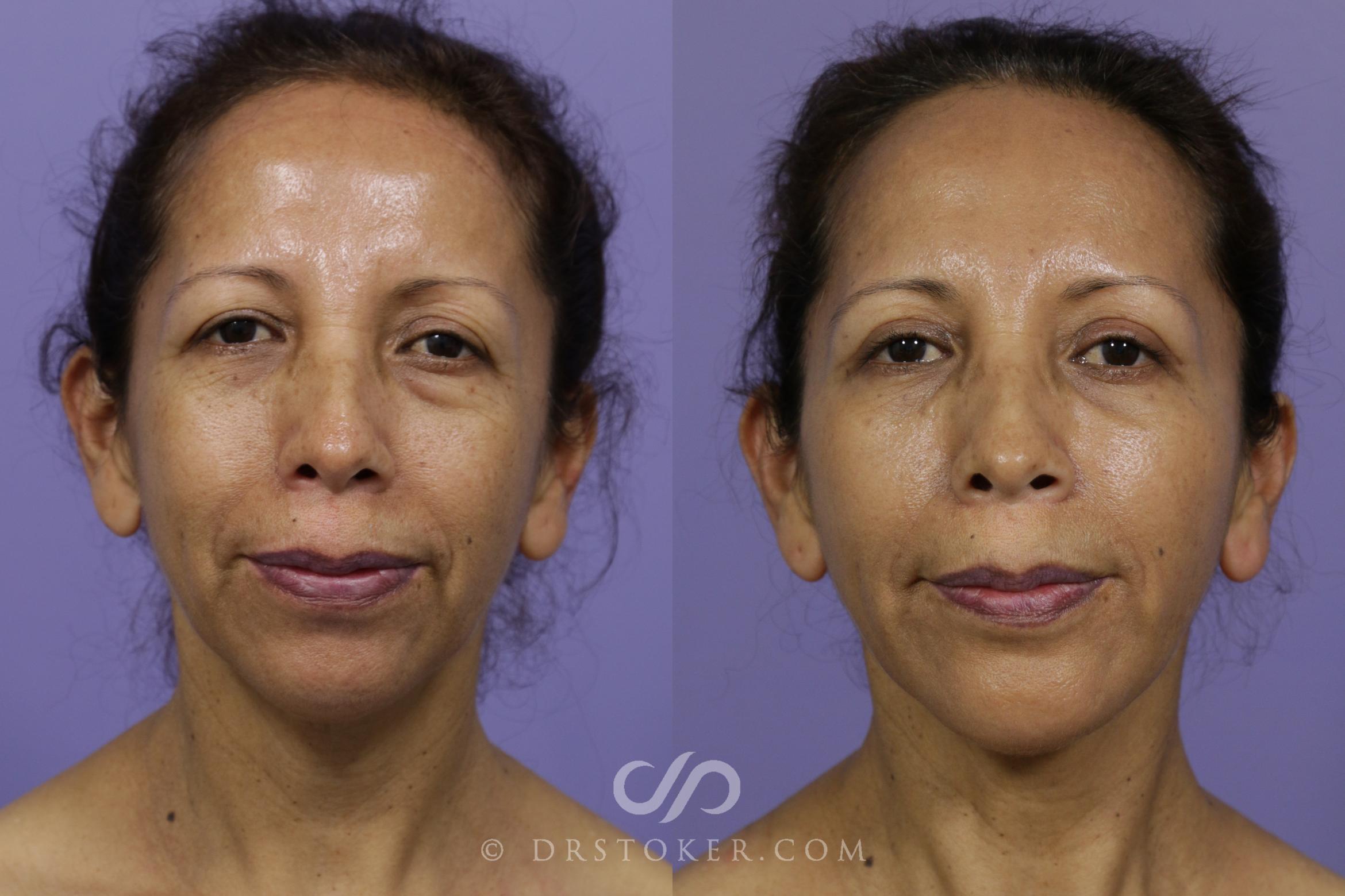 Before & After Cheek Fillers Case 1598 View #1 View in Marina del Rey, CA