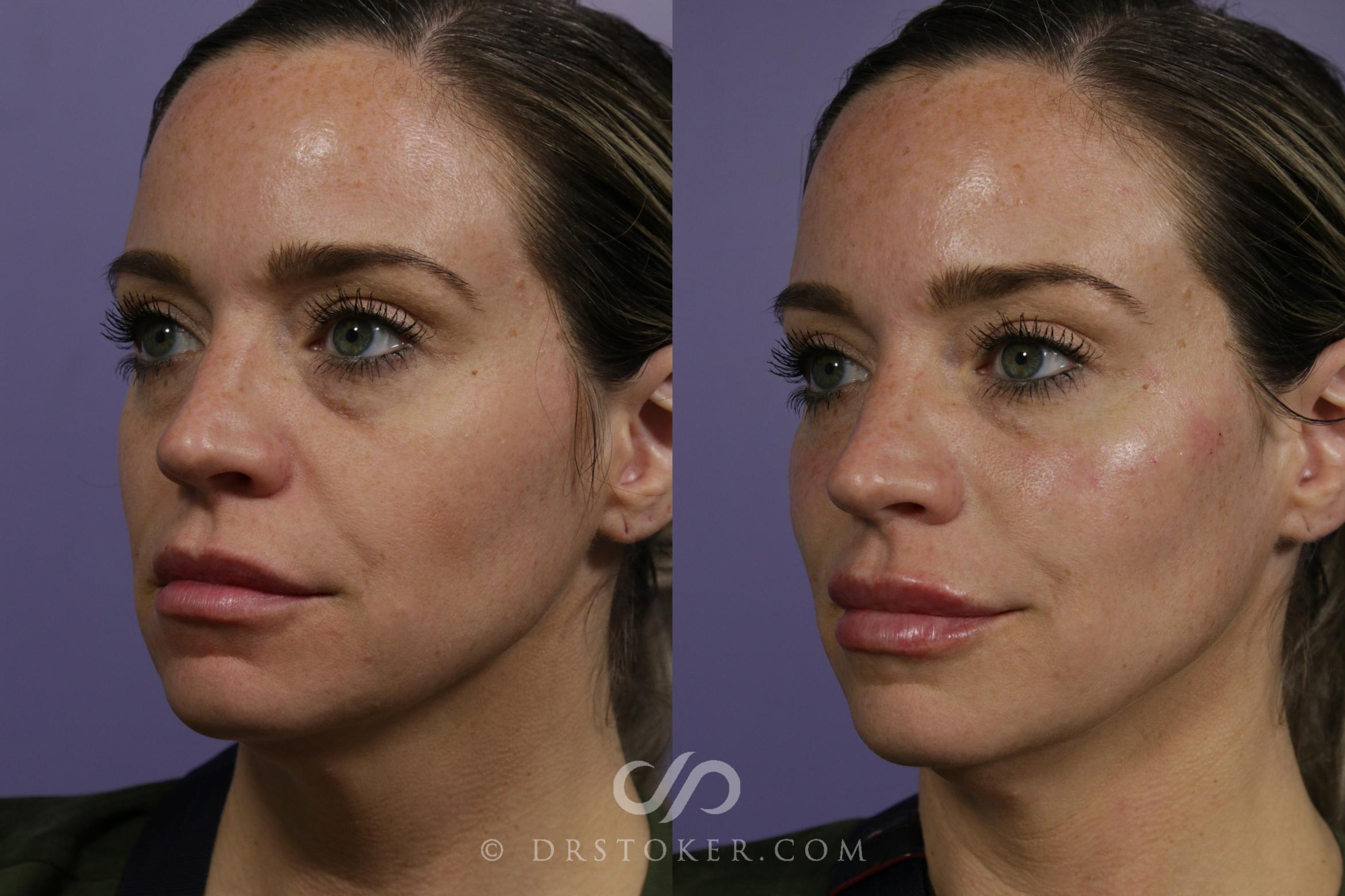 Before & After Cheek Fillers Case 1622 View #1 View in Marina del Rey, CA