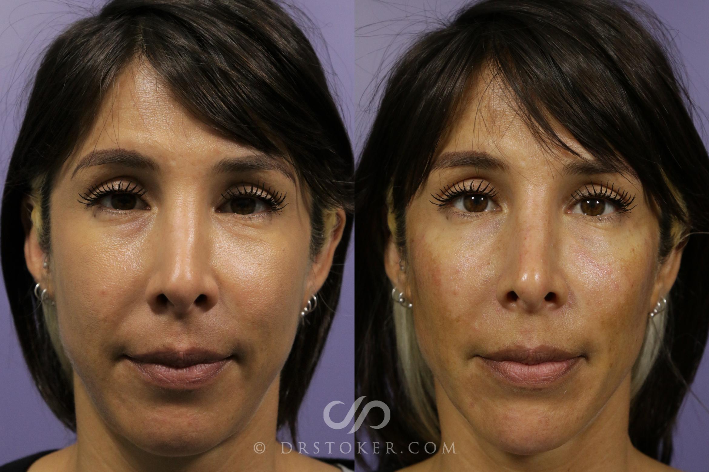 Before & After Cheek Fillers Case 1859 Front View in Marina del Rey, CA
