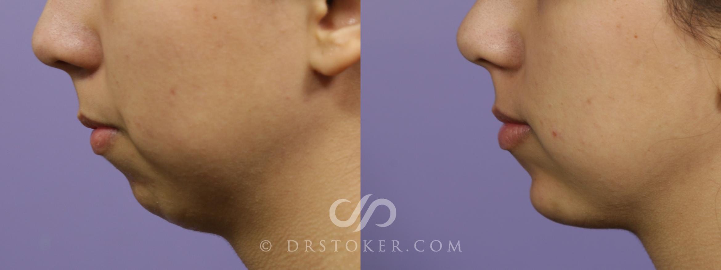 Before & After Chin Fillers/Augmentation Case 1643 View #1 View in Marina del Rey, CA