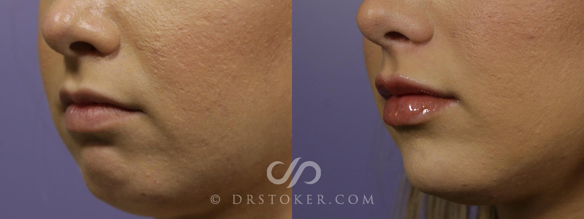 Before & After Chin Fillers/Augmentation Case 1653 View #1 View in Los Angeles, CA