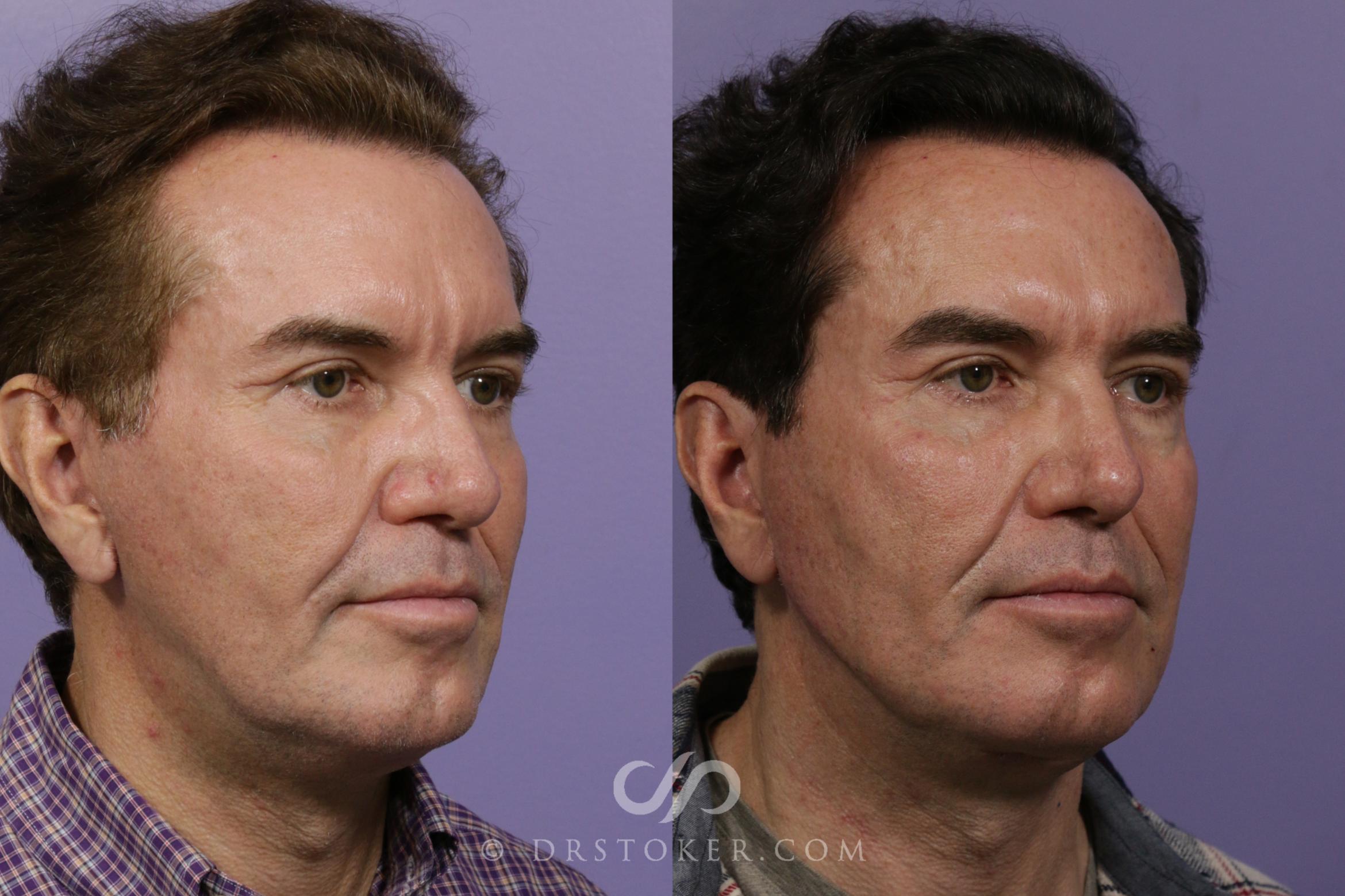 Before & After Jawline Fillers Case 1975 Right Oblique View in Los Angeles, CA