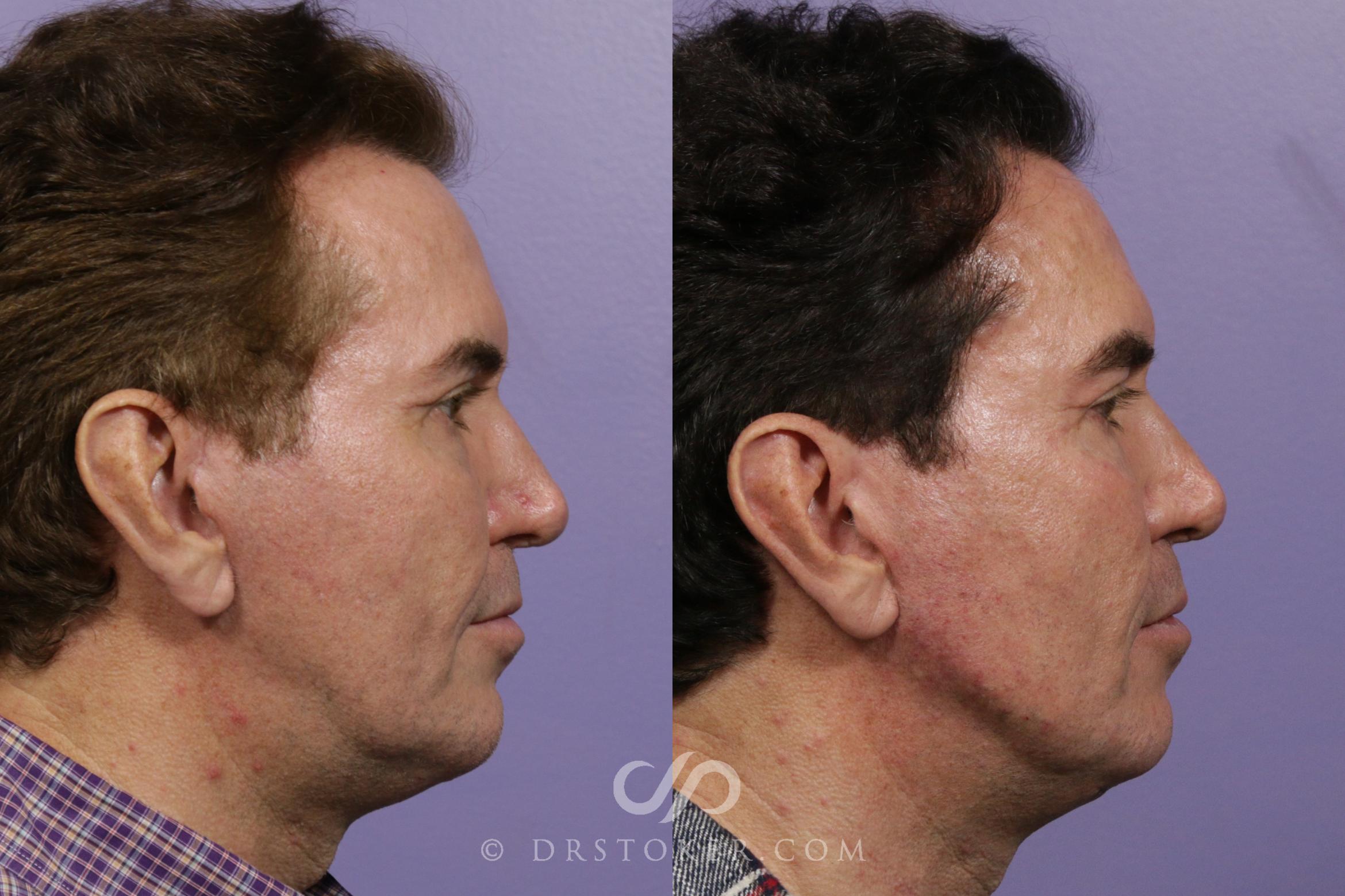 Before & After Jawline Fillers Case 1977 Right Side View in Marina del Rey, CA